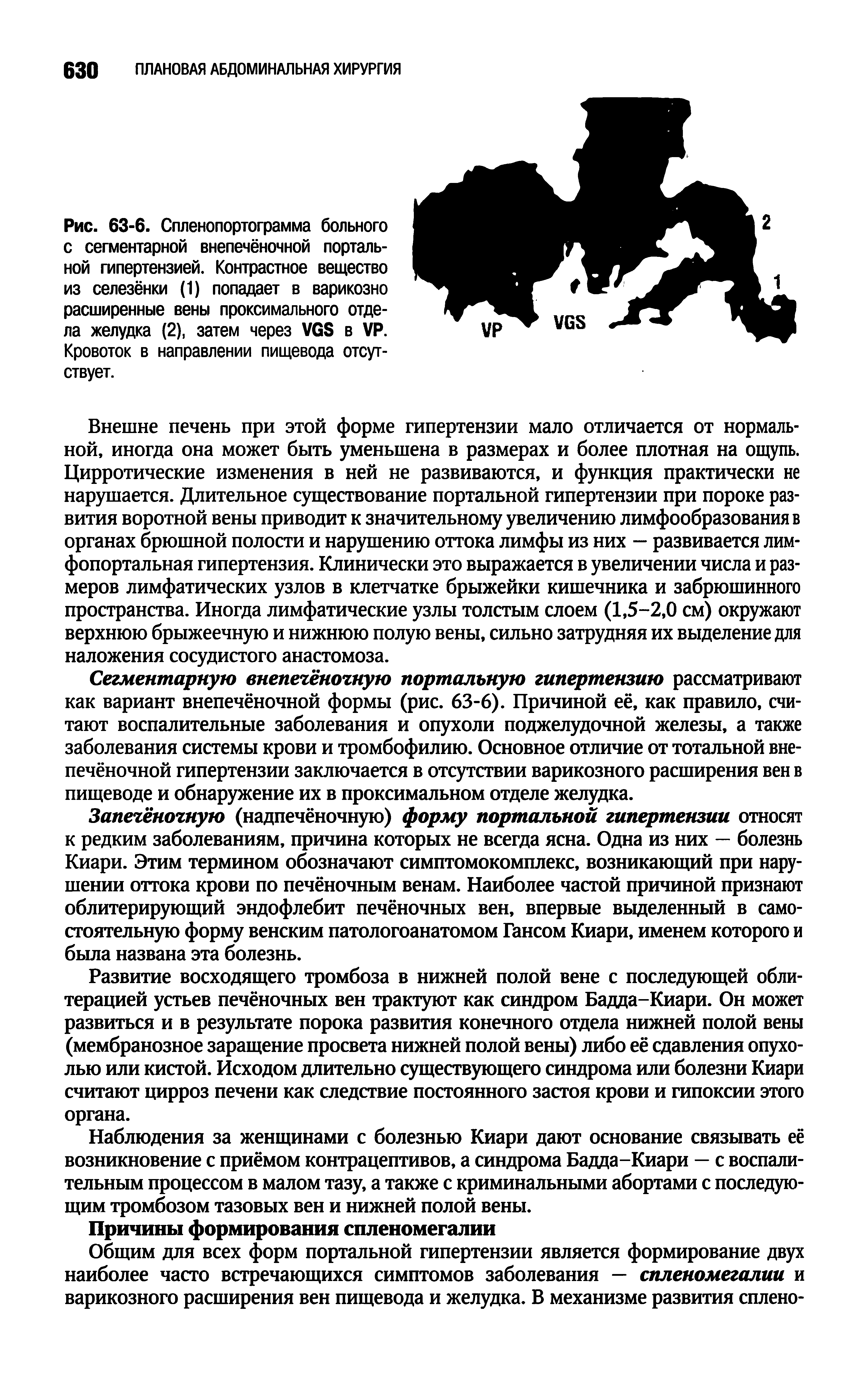 Рис. 63-6. Спленопортограмма больного с сегментарной внепечёночной портальной гипертензией. Контрастное вещество из селезёнки (1) попадает в варикозно расширенные вены проксимального отдела желудка (2), затем через VGS в VP. Кровоток в направлении пищевода отсутствует.