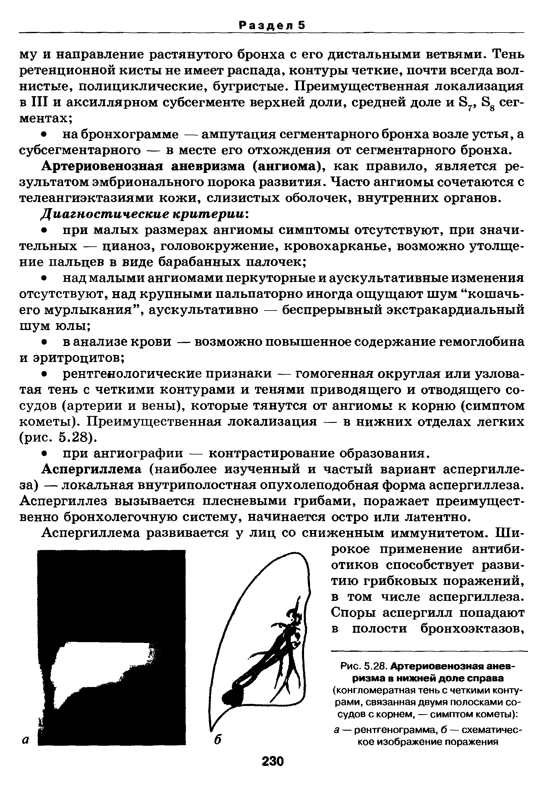 Рис. 5.28. Артериовенозная аневризма в нижней доле справа (конгломератная тень с четкими контурами, связанная двумя полосками сосудов с корнем, — симптом кометы) а — рентгенограмма, б — схематическое изображение поражения...