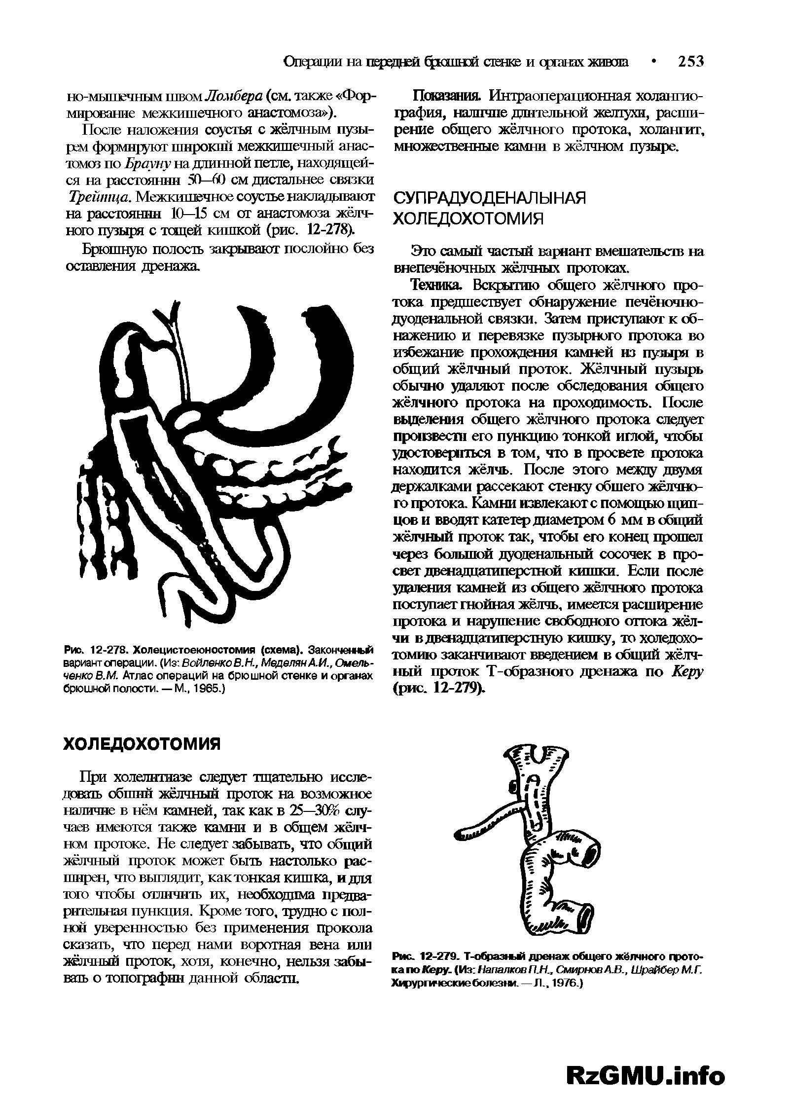 Рис. 12-278. Холецистоеюностомия (схема). Законченная вариант операции. (Из ВоМленкоВ.Н.,Меделян А.И., Омельченко В.М. Атлас операций на брюшной стенке и органах брюшной полости. — М., 1965.)...