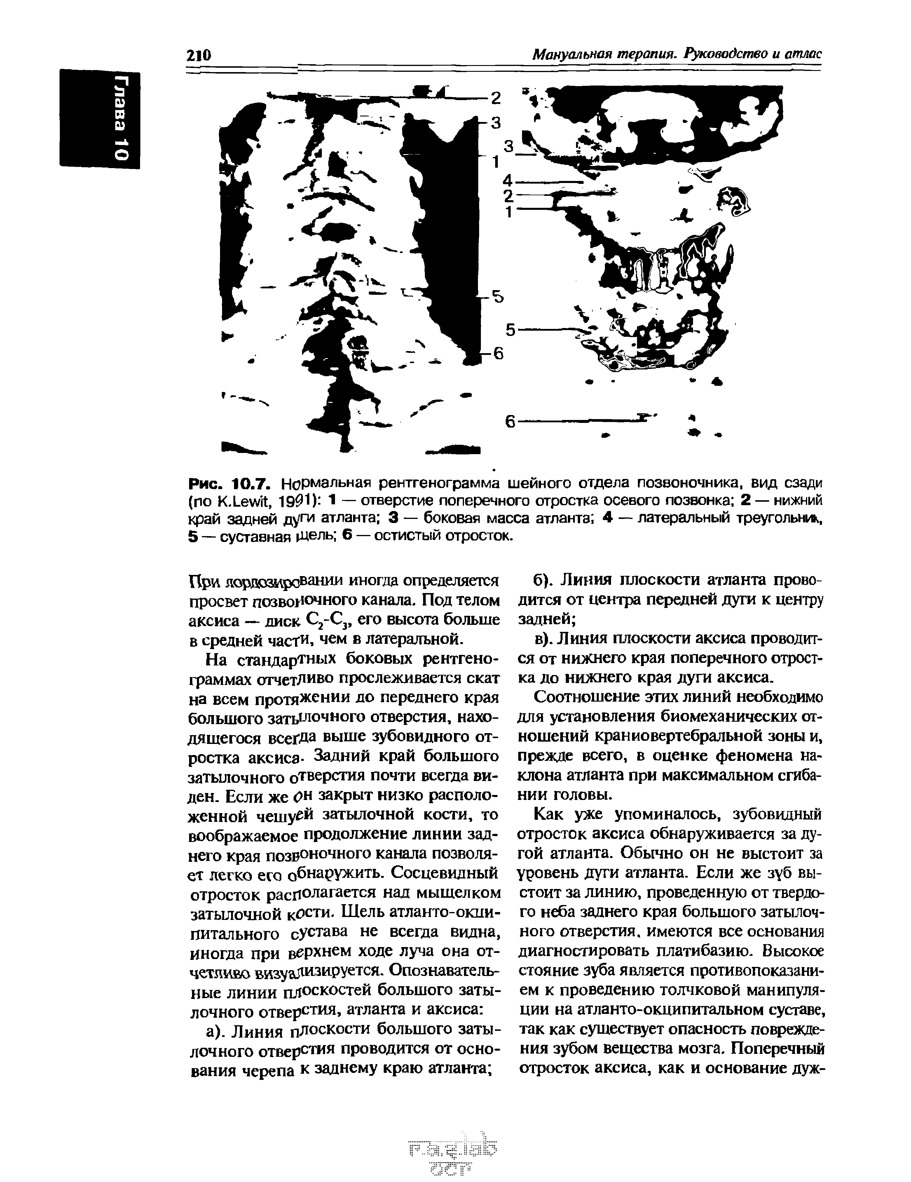Рис. 10.7. Нормальная рентгенограмма шейного отдела позвоночника, вид сзади (по К.ЬеюК, 1901) 1 — отверстие поперечного отростка осевого позвонка 2 — нижний край задней дуги атланта 3 — боковая масса атланта 4 — латеральный треугольник, 5 — суставная щель 6 — остистый отросток.