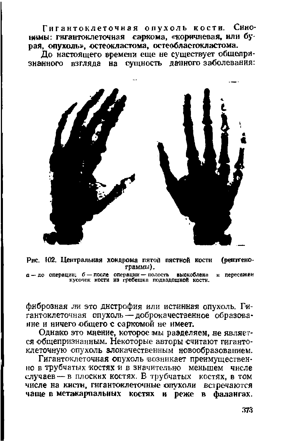 Рис. 102. Центральная хондрома пятой пястной кости (рентгенограммы).