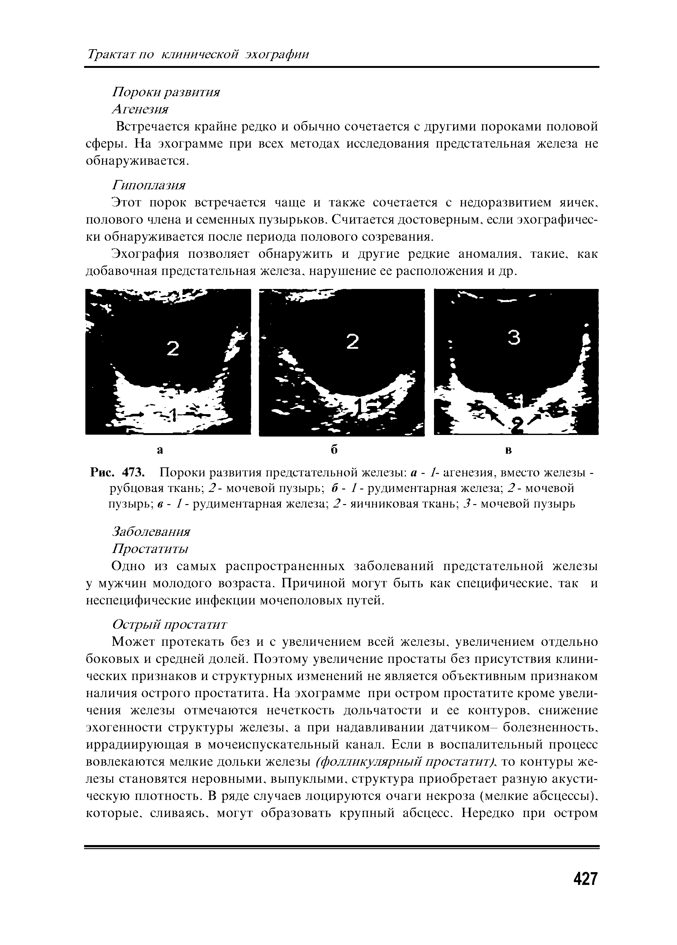 Рис. 473. Пороки развития предстательной железы а - 1- агенезия, вместо железы -рубцовая ткань 2- мочевой пузырь б - 1 - рудиментарная железа 2- мочевой пузырь в - 1 - рудиментарная железа 2- яичниковая ткань 3- мочевой пузырь...