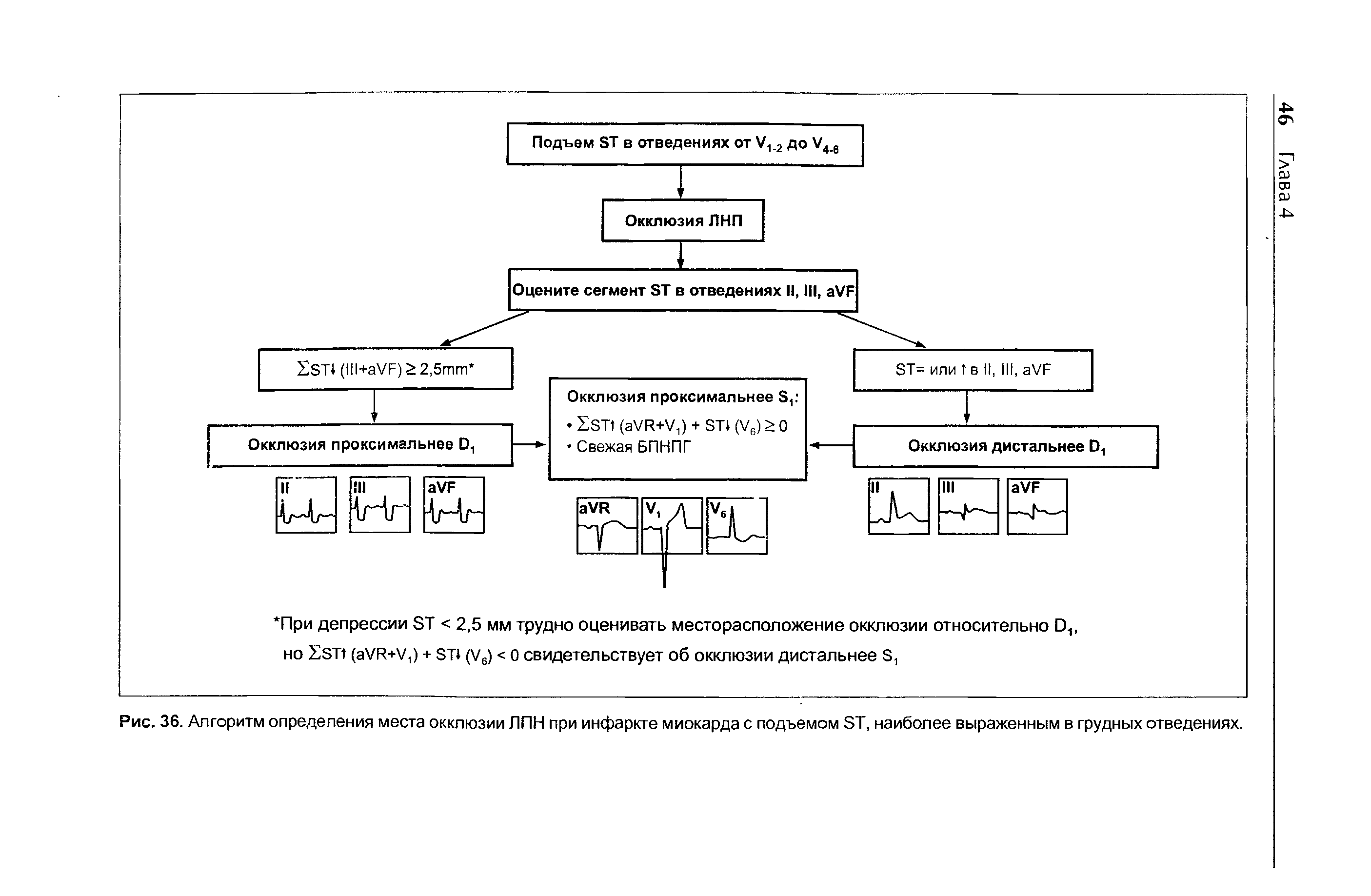 Рис. 36. Алгоритм определения места окклюзии ЛПН при инфаркте миокарда с подъемом БТ, наиболее выраженным в грудных отведениях.