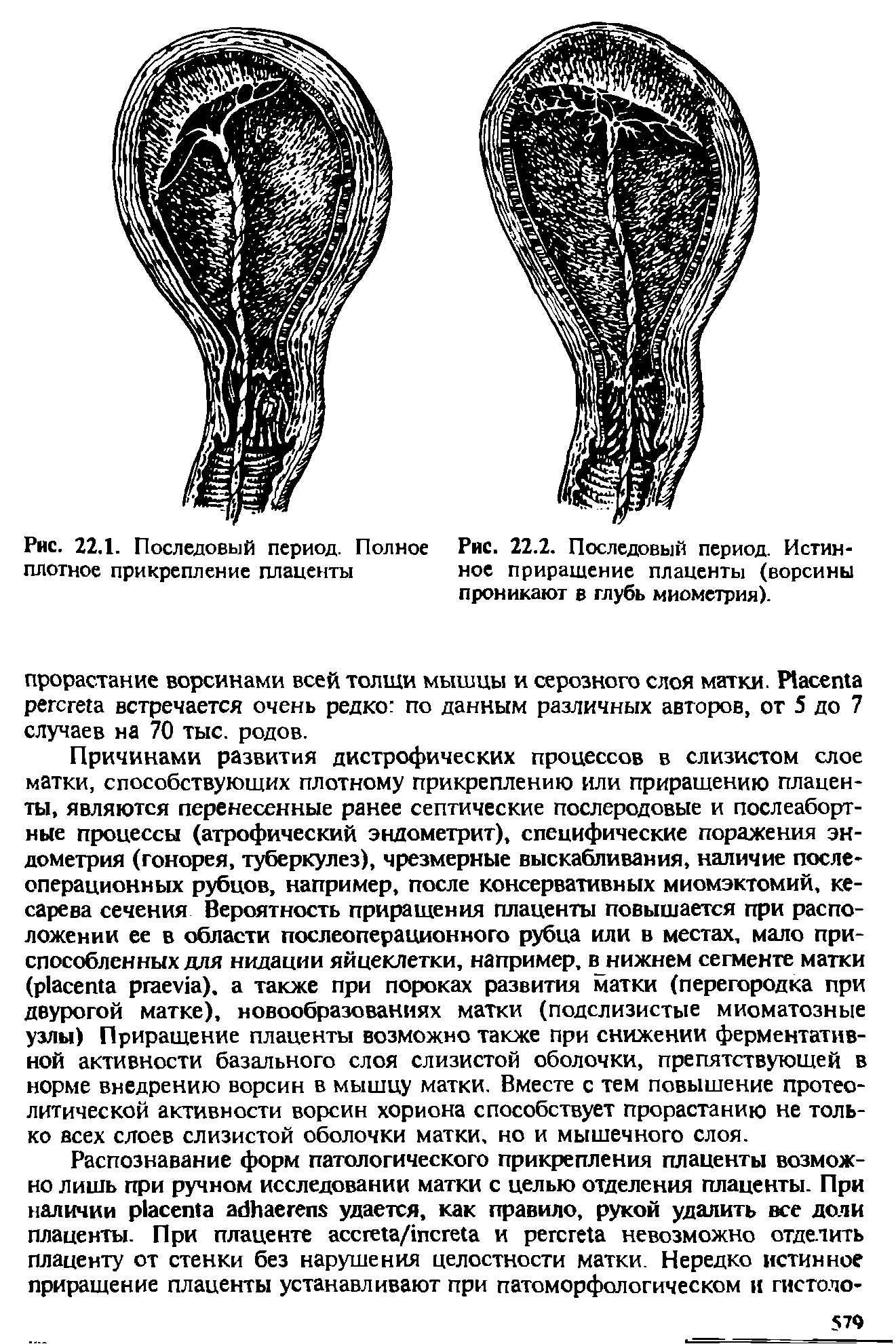 Рис. 22.2. Последовый период. Истинное приращение плаценты (ворсины проникают в глубь миометрия).