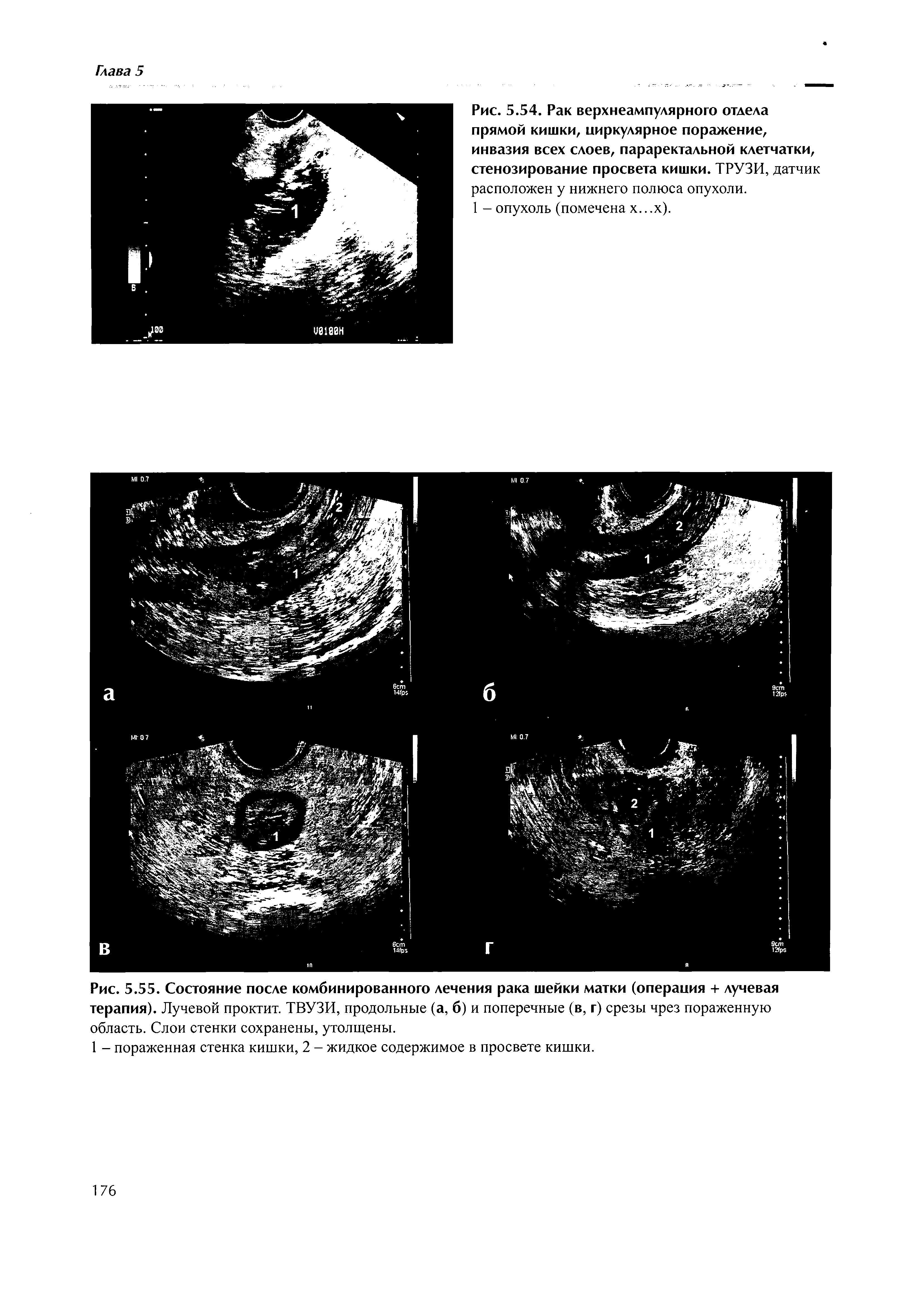 Рис. 5.55. Состояние после комбинированного лечения рака шейки матки (операция + лучевая терапия). Лучевой проктит. ТВУЗИ, продольные (а, б) и поперечные (в, г) срезы чрез пораженную область. Слои стенки сохранены, утолщены.