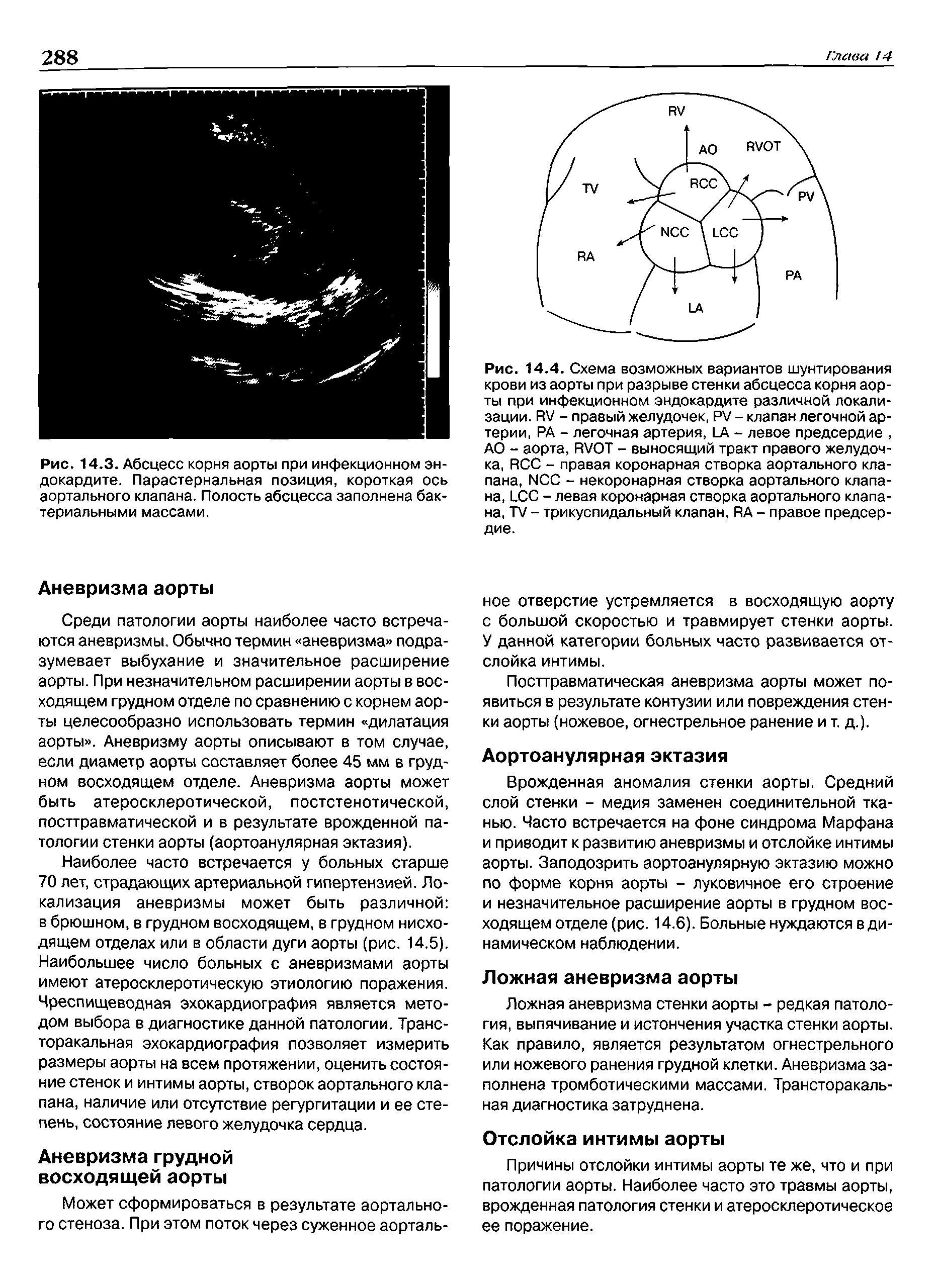 Рис. 14.3. Абсцесс корня аорты при инфекционном эндокардите. Парастернальная позиция, короткая ось аортального клапана. Полость абсцесса заполнена бактериальными массами.