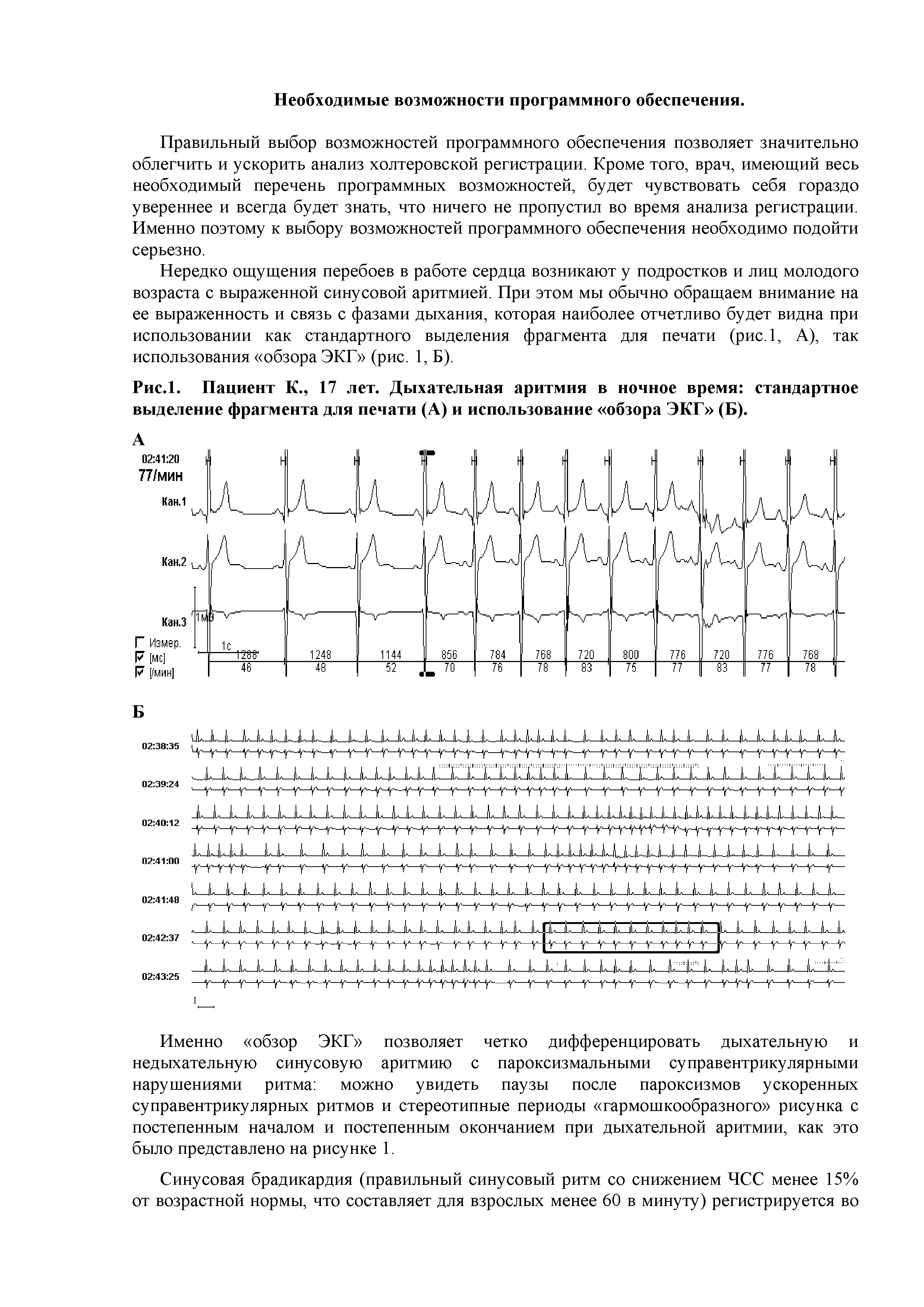 Рис.1. Пациент К., 17 лет. Дыхательная аритмия в ночное время стандартное выделение фрагмента для печати (А) и использование обзора ЭКГ (Б).