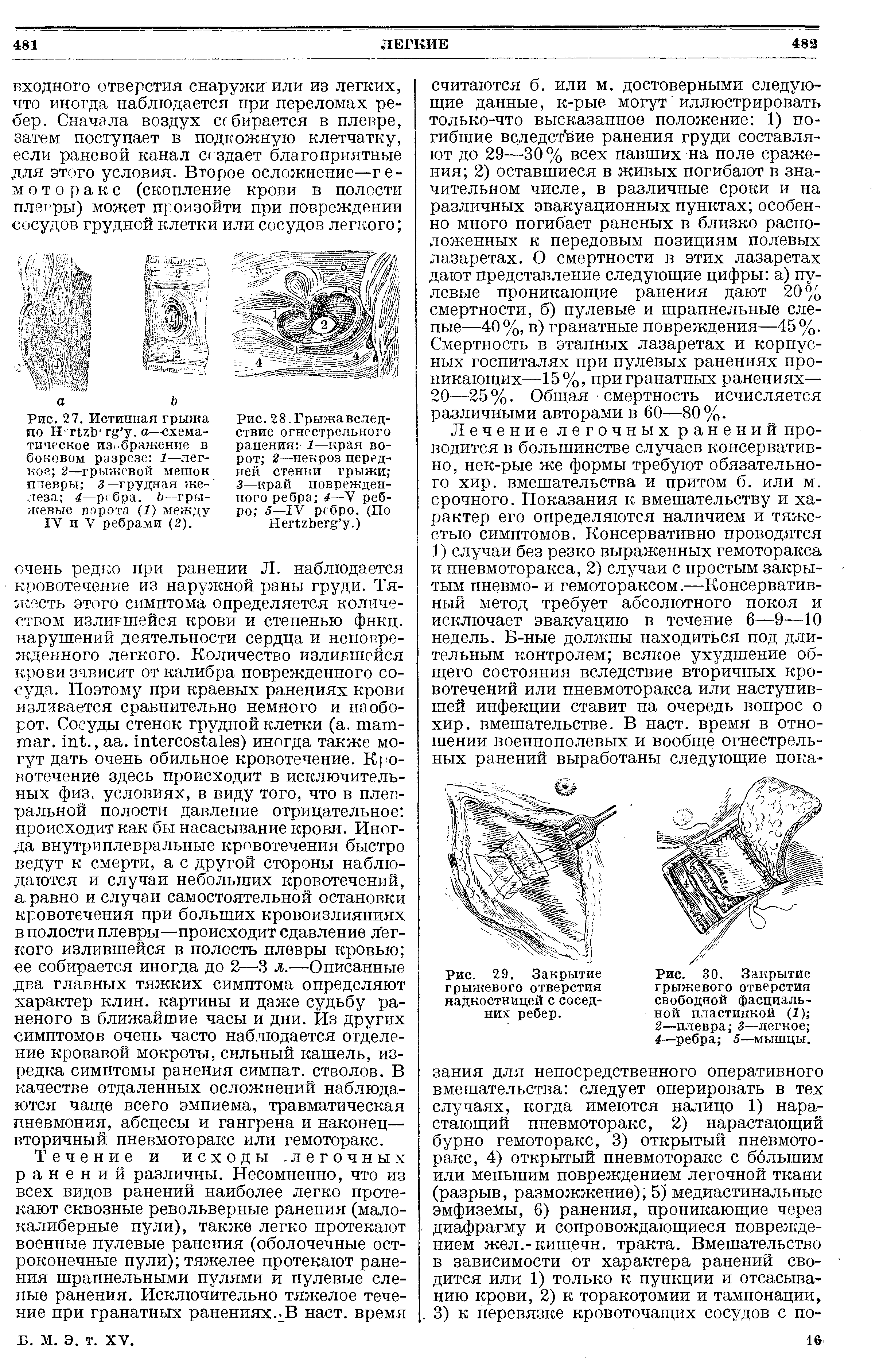 Рис. 27. Истинная грыжа по Н ШЬ г г у. а—схематическое изображение в боковом разрезе 1—легкое 2—грыжевой мешок плевры 3—грудная же- леза 4—ребра. Ь— грыжевые ворота (1) между IV и V ребрами (2).