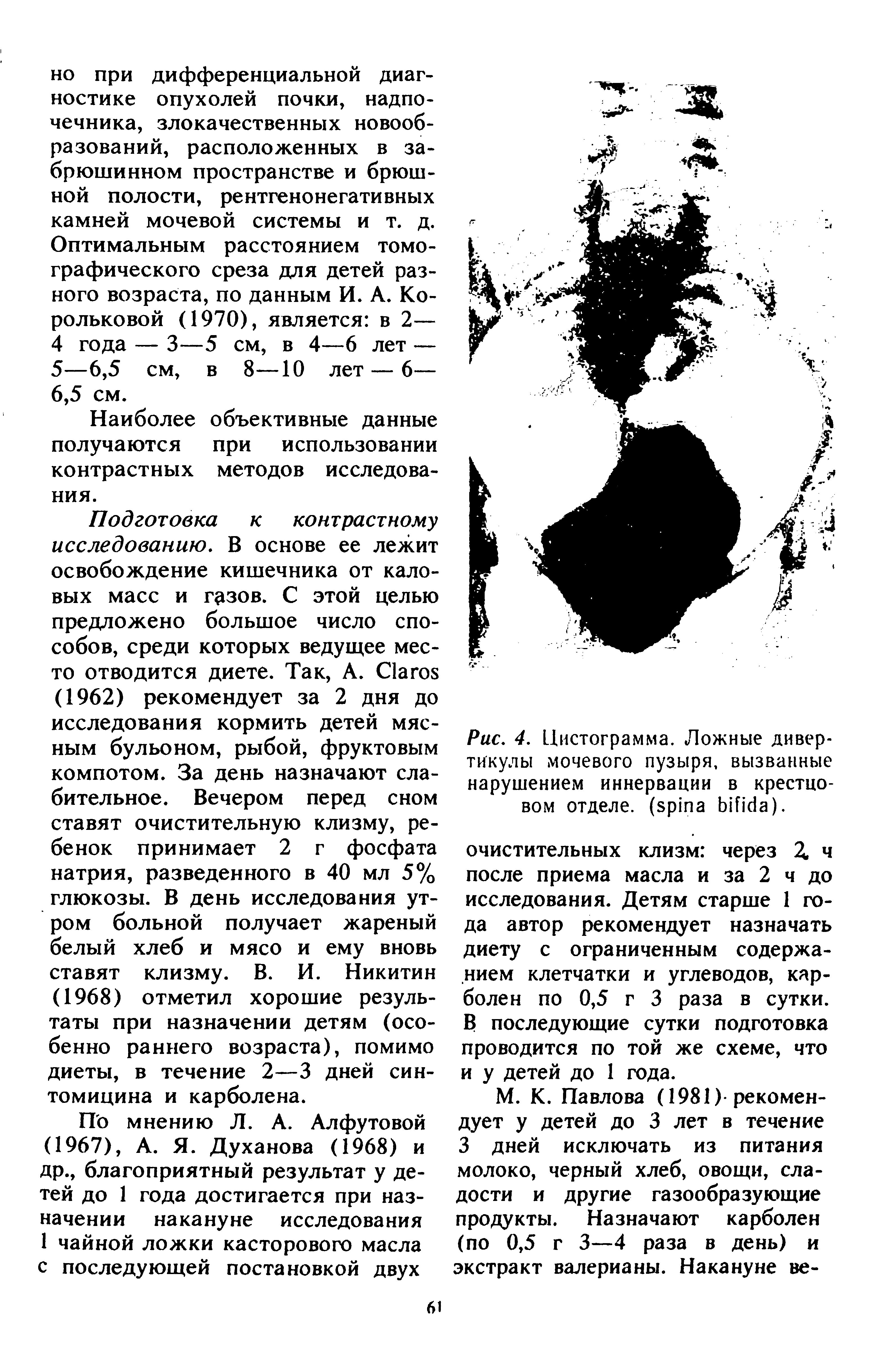 Рис. 4. Цистограмма. Ложные дивертикулы мочевого пузыря, вызванные нарушением иннервации в крестцовом отделе, ( ).