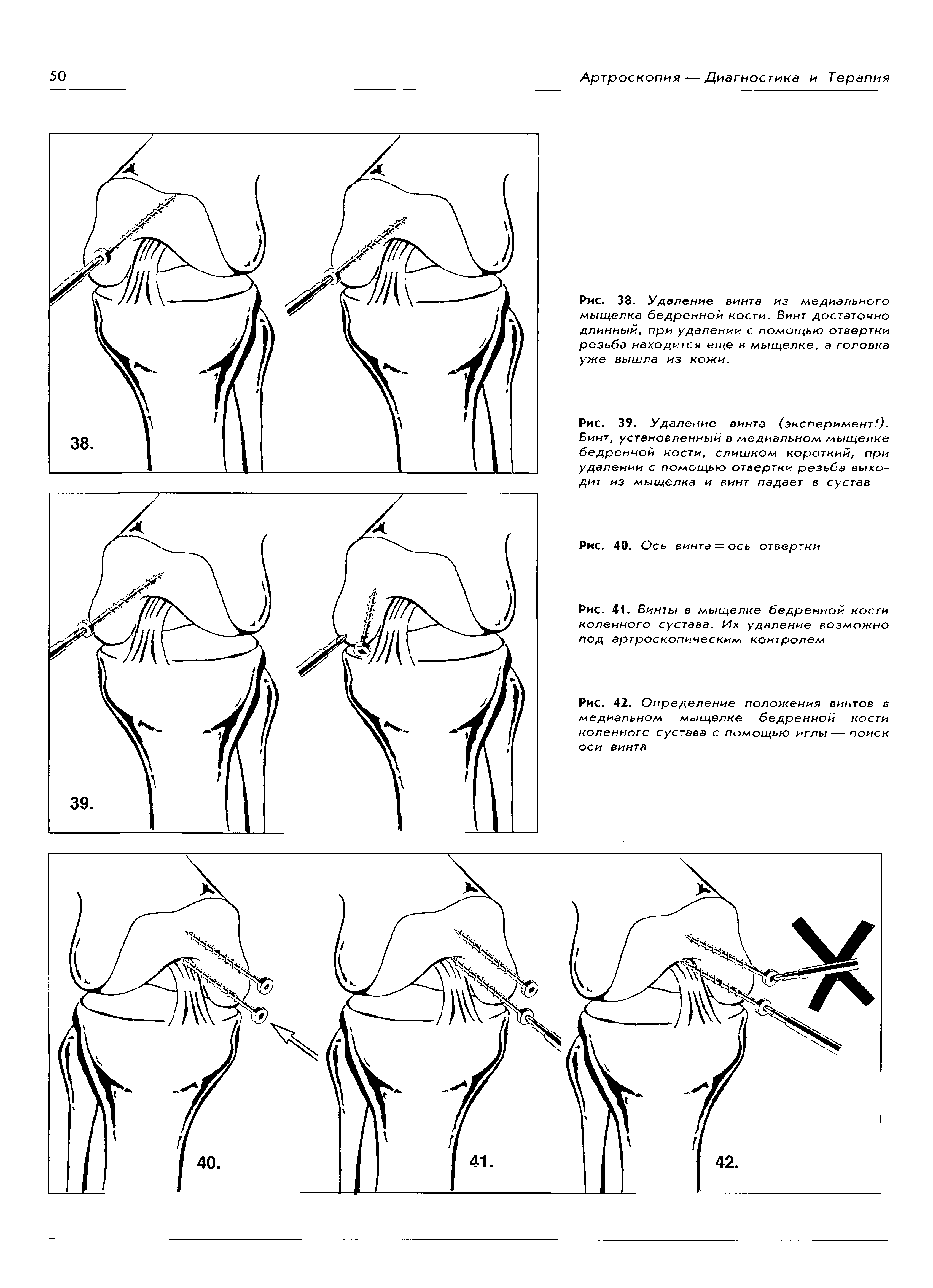 Рис. 39. Удаление винта (эксперимент ). Винт, установленный в медиальном мыщелке бедренной кости, слишком короткий, при удалении с помощью отвертки резьба выходит из мыщелка и винт падает в сустав...