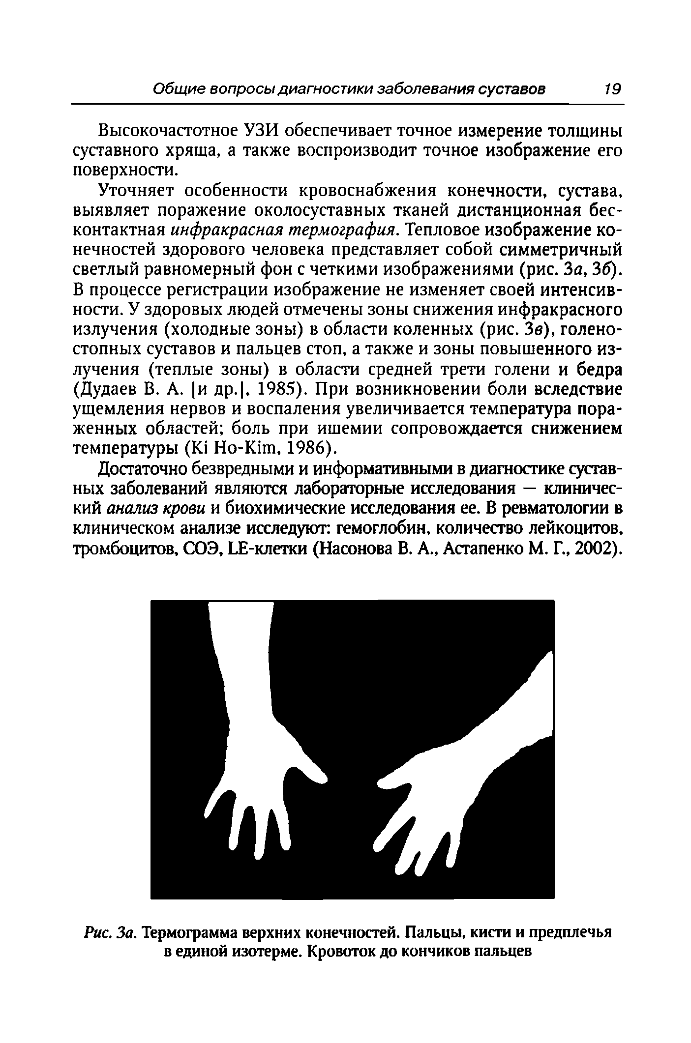 Рис. За. Термограмма верхних конечностей. Пальцы, кисти и предплечья в единой изотерме. Кровоток до кончиков пальцев...