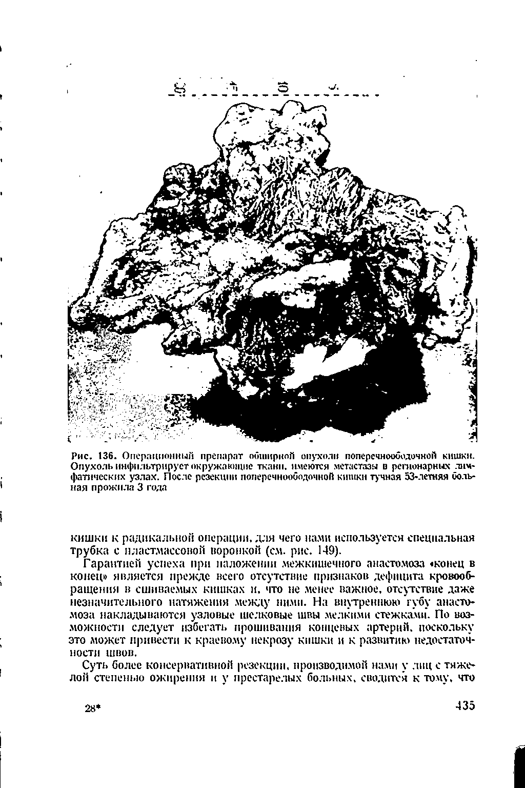 Рис. 136. Операционный препарат обширной опухоли поперечнооболочной кишки. Опухоль инфильтрирует окружающие ткани, имеются метастазы в регионарных лимфатических узлах. После резекции поперечноободочной кишки тучная 53-летняя больная прожила 3 года...