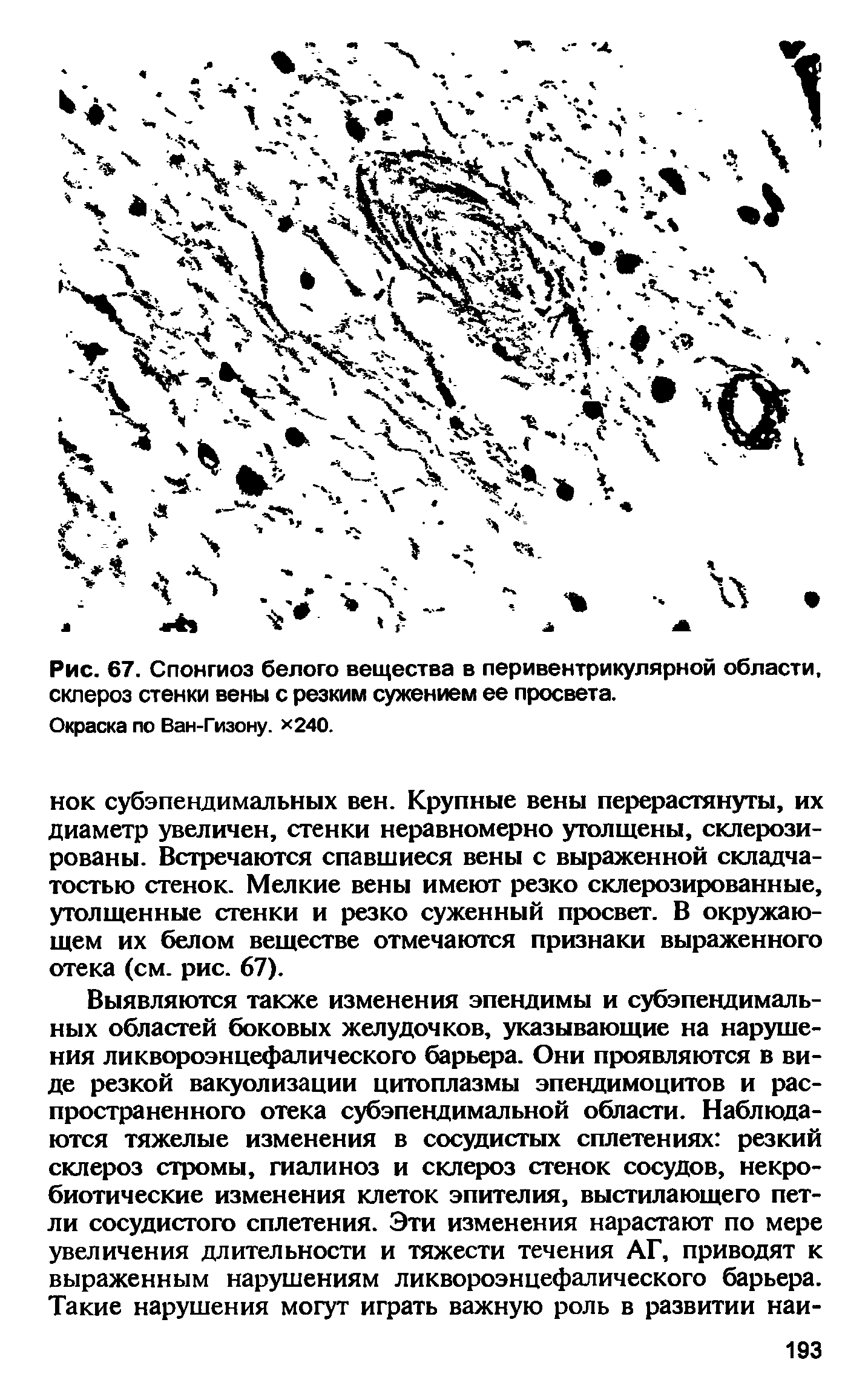 Рис. 67. Спонгиоз белого вещества в перивентрикулярной области, склероз стенки вены с резким сужением ее просвета.