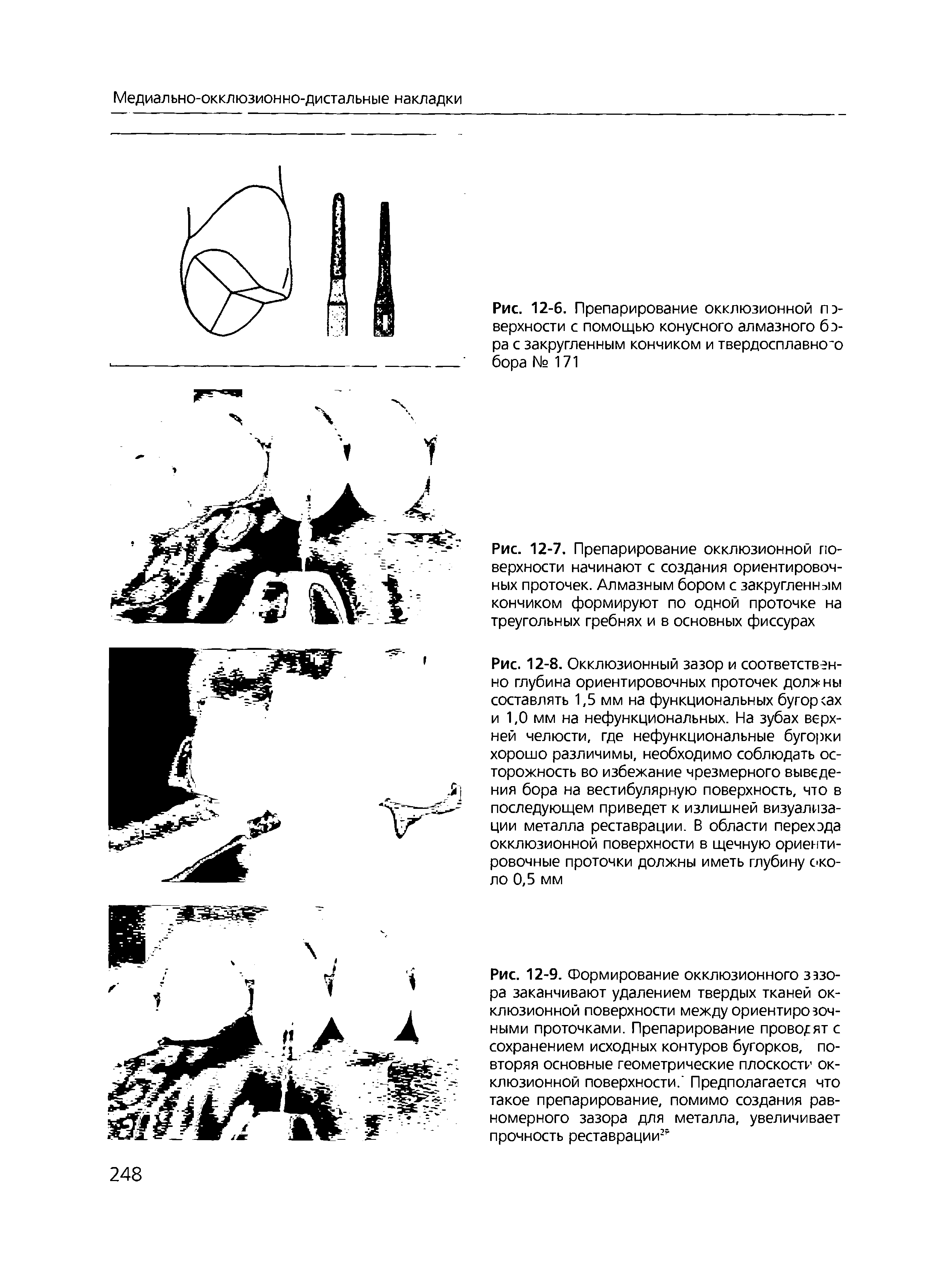 Рис. 12-6. Препарирование окклюзионной поверхности с помощью конусного алмазного бора с закругленным кончиком и твердосплавного бора № 171...