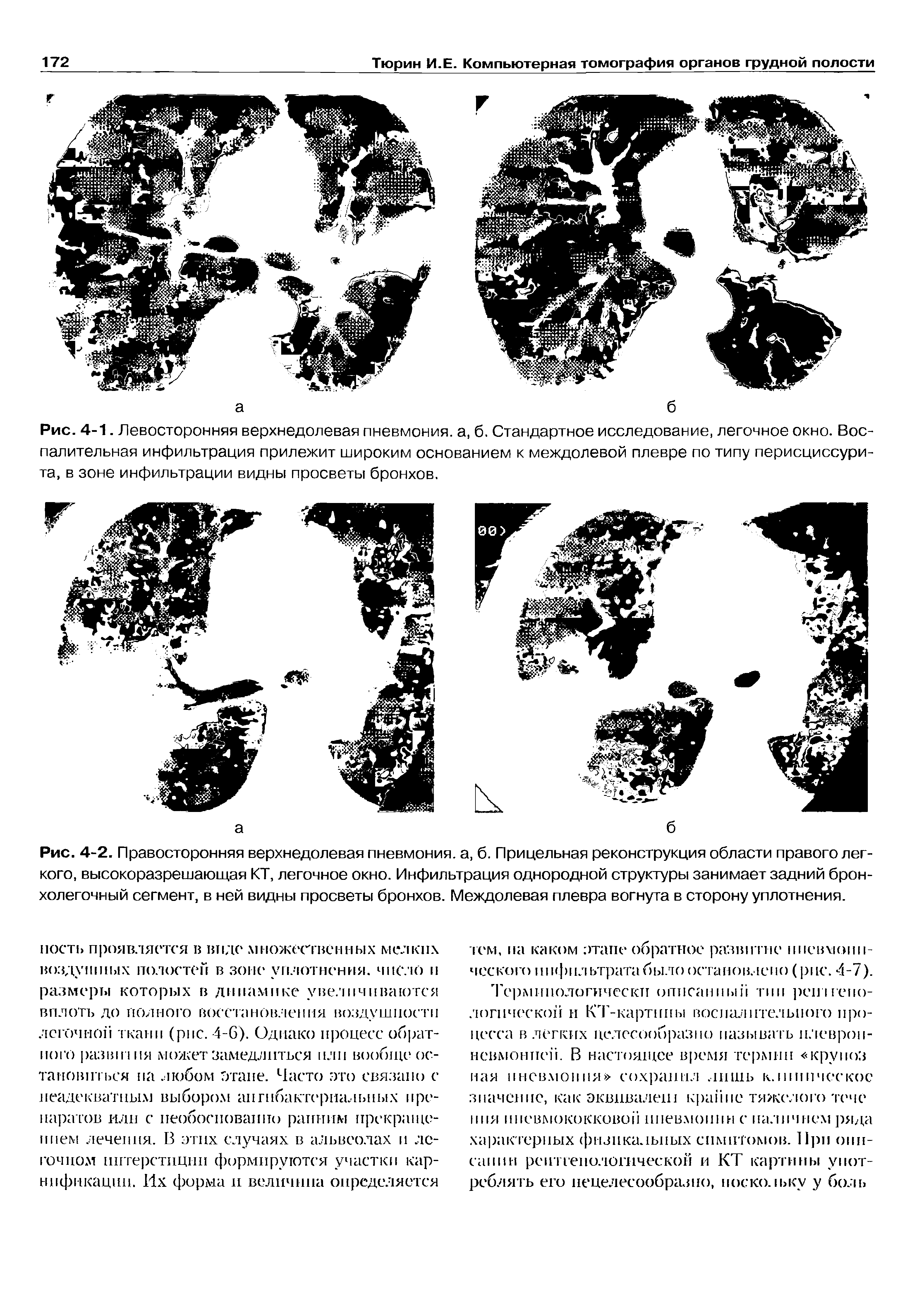 Рис. 4-2. Правосторонняя верхнедолевая пневмония, а, б. Прицельная реконструкция области правого легкого, высокоразрешающая КТ, легочное окно. Инфильтрация однородной структуры занимает задний бронхолегочный сегмент, в ней видны просветы бронхов. Междолевая плевра вогнута в сторону уплотнения.