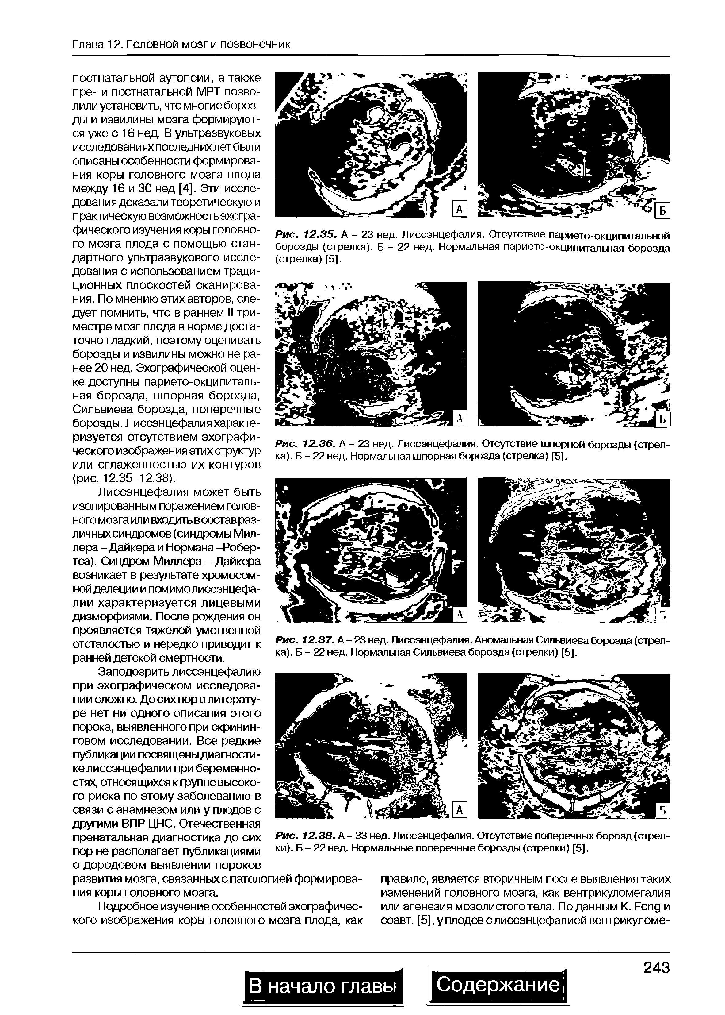 Рис. 12.35. А - 23 нед. Лиссэнцефалия. Отсутствие парието-окципитальной борозды (стрелка). Б - 22 нед. Нормальная парието-окципитальная борозда (стрелка) [5].