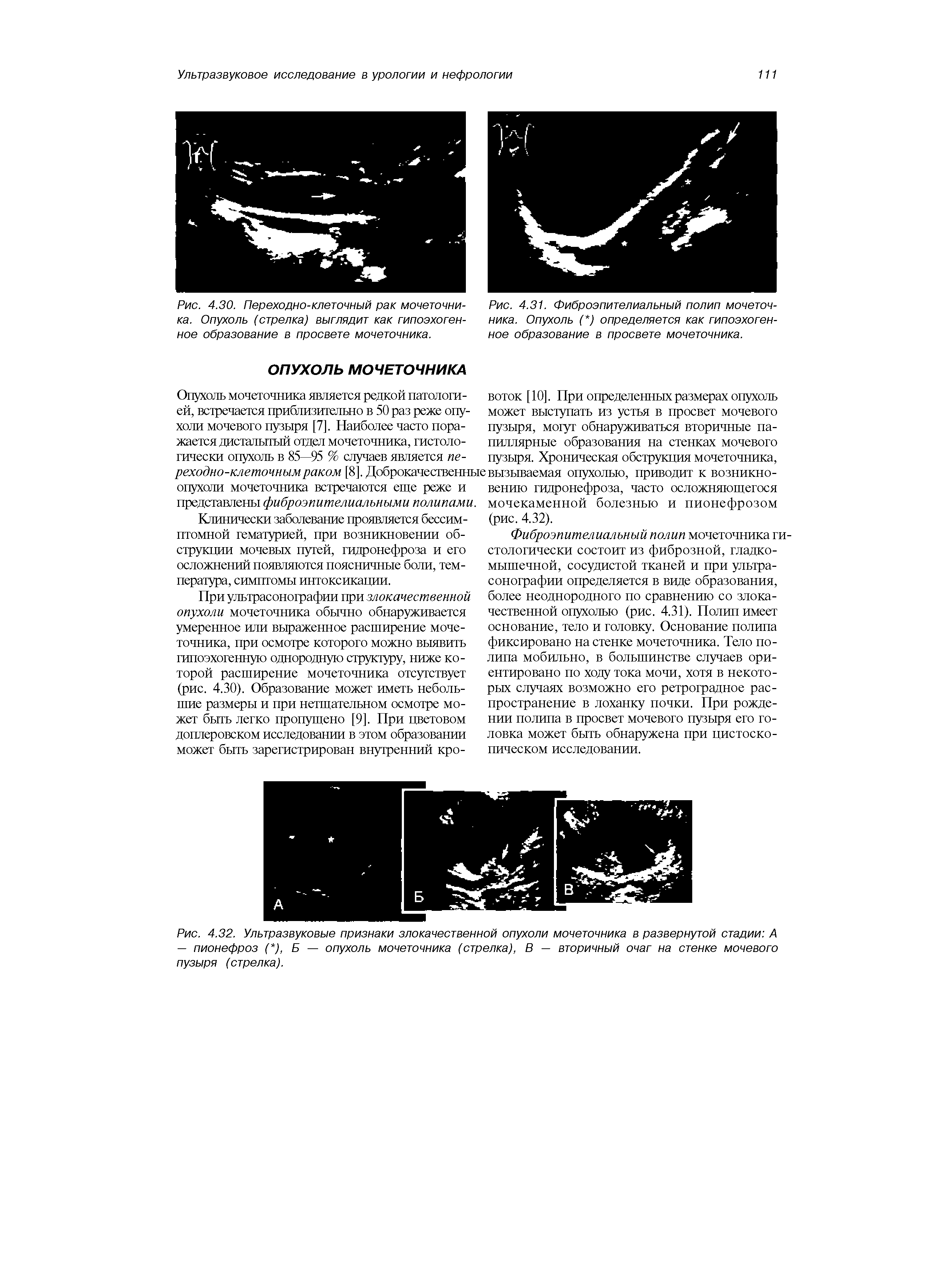 Рис. 4.31. Фиброэпителиальный полип мочеточника. Опухоль ( ) определяется как гипоэхоген-ное образование в просвете мочеточника.