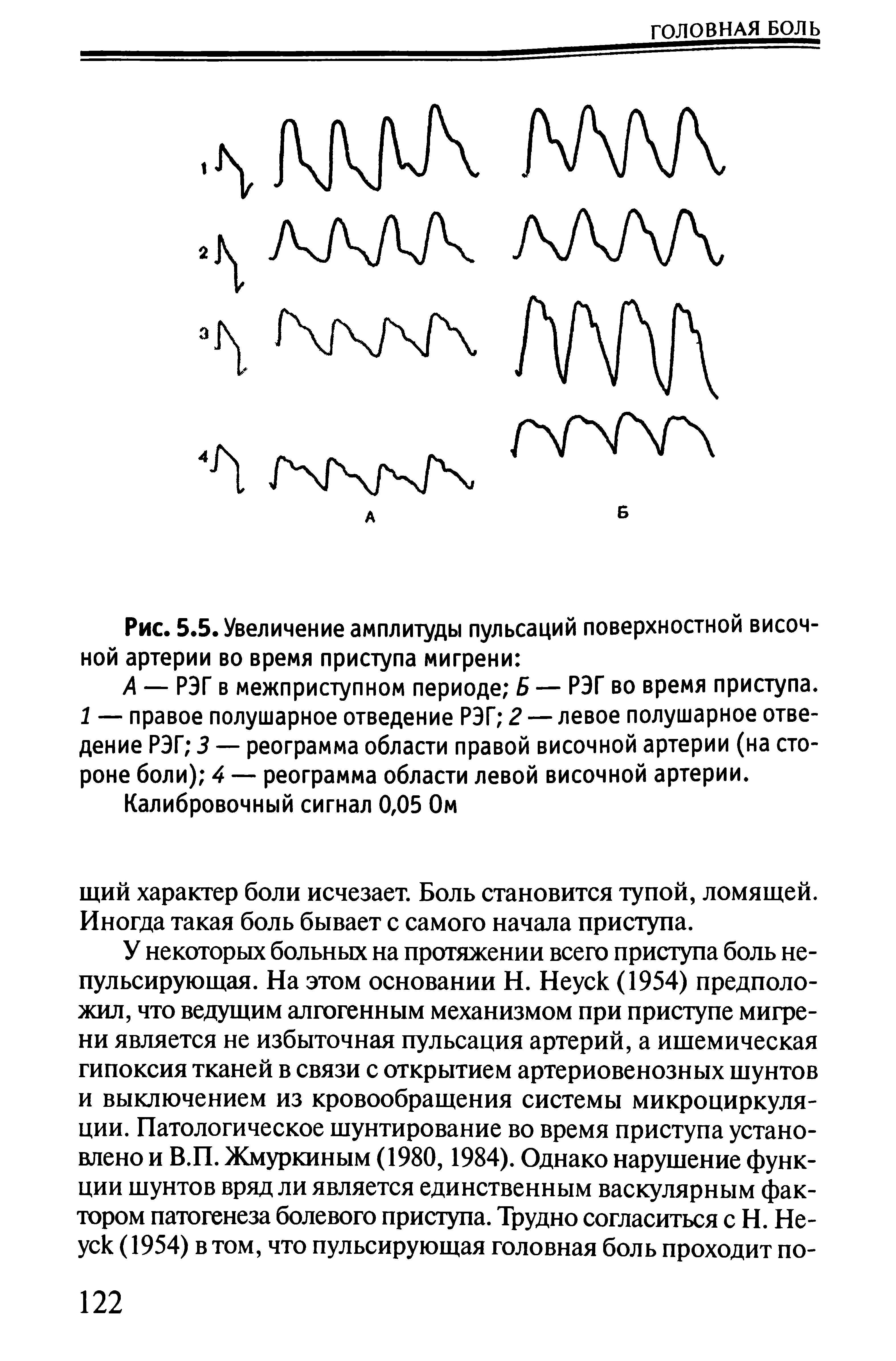 Рис. 5.5. Увеличение амплитуды пульсаций поверхностной височной артерии во время приступа мигрени ...