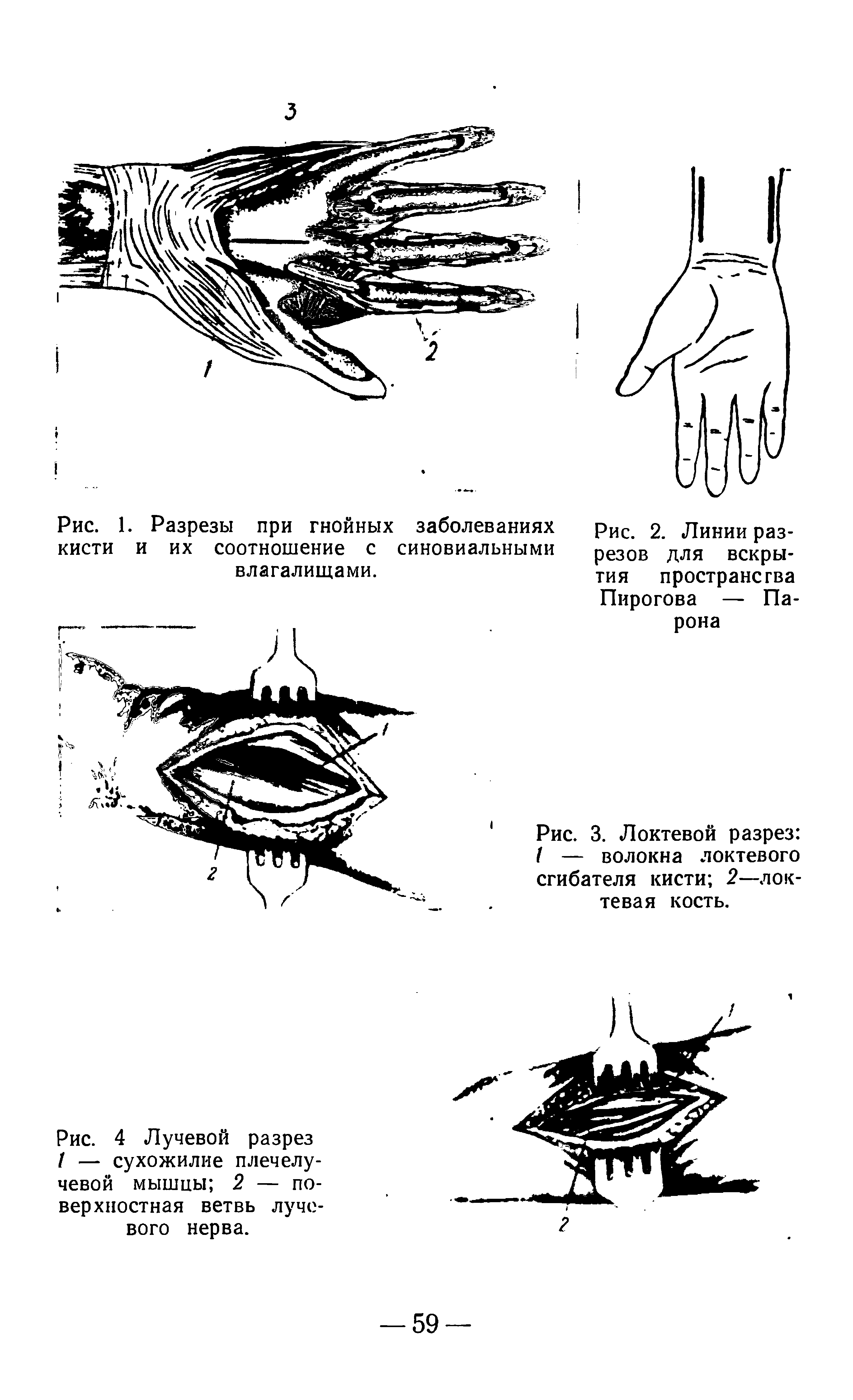 Рис. 3. Локтевой разрез I — волокна локтевого сгибателя кисти 2—локтевая кость.