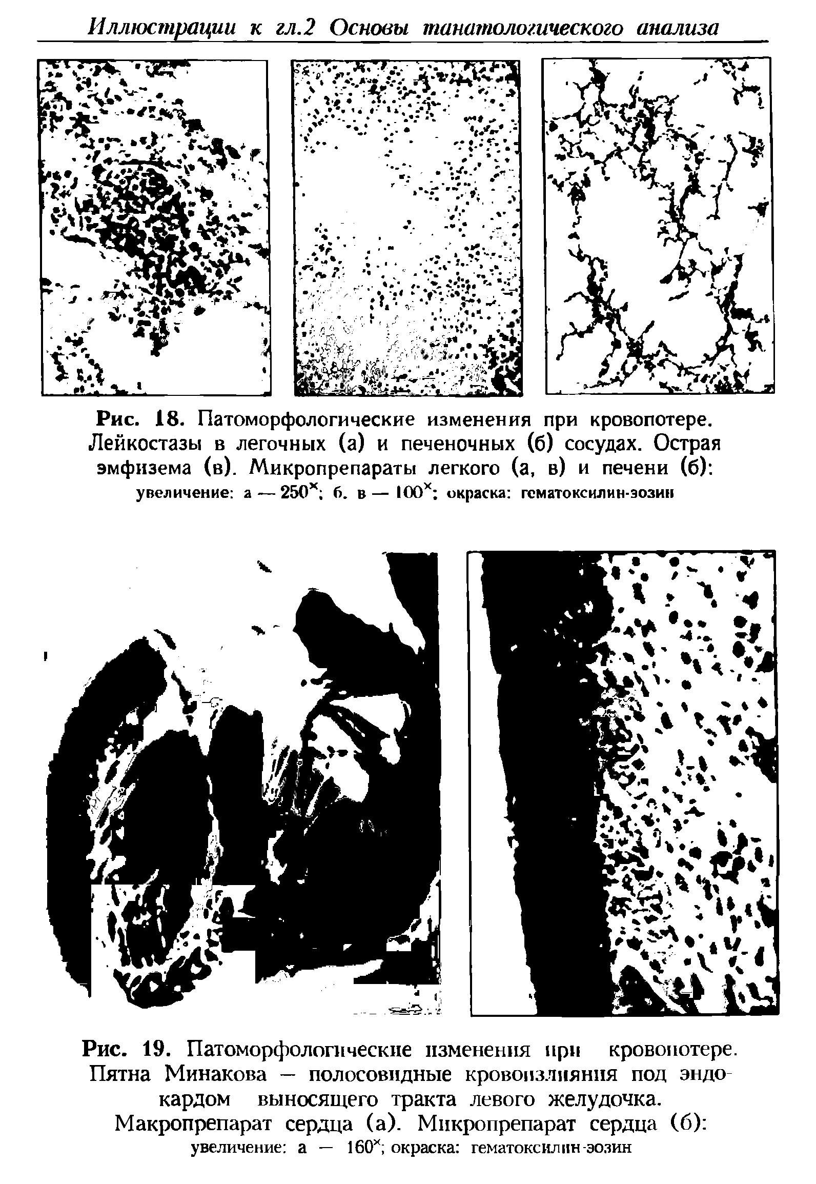 Рис. 19. Патоморфологические изменения при кровопотере. Пятна Минакова — полосовидные кровоизлияния под эндо кардом выносящего тракта левого желудочка. Макропрепарат сердца (а). Микропрепарат сердца (б) увеличение а — 160х окраска гематоксилин-эозин...