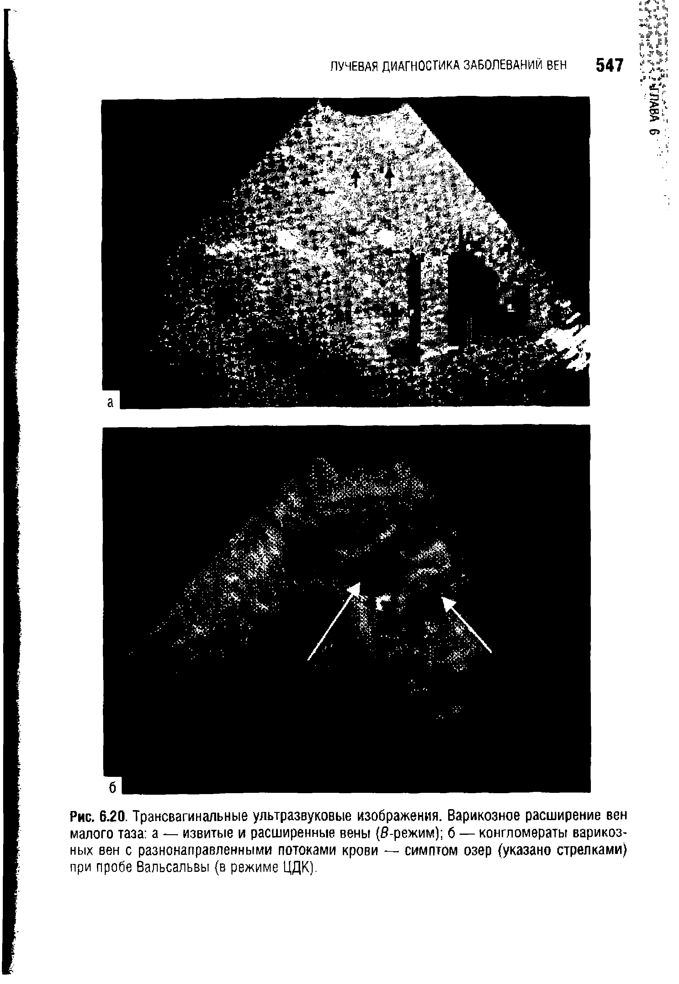Рис. 6.20. Трансвагинальные ультразвуковые изображения. Варикозное расширение вен малого таза а — извитые и расширенные вены (б-режим) б — конгломераты варикозных вен с разнонаправленными потоками крови — симптом озер (указано стрелками) при пробе Вальсальвы (в режиме ЦДК).
