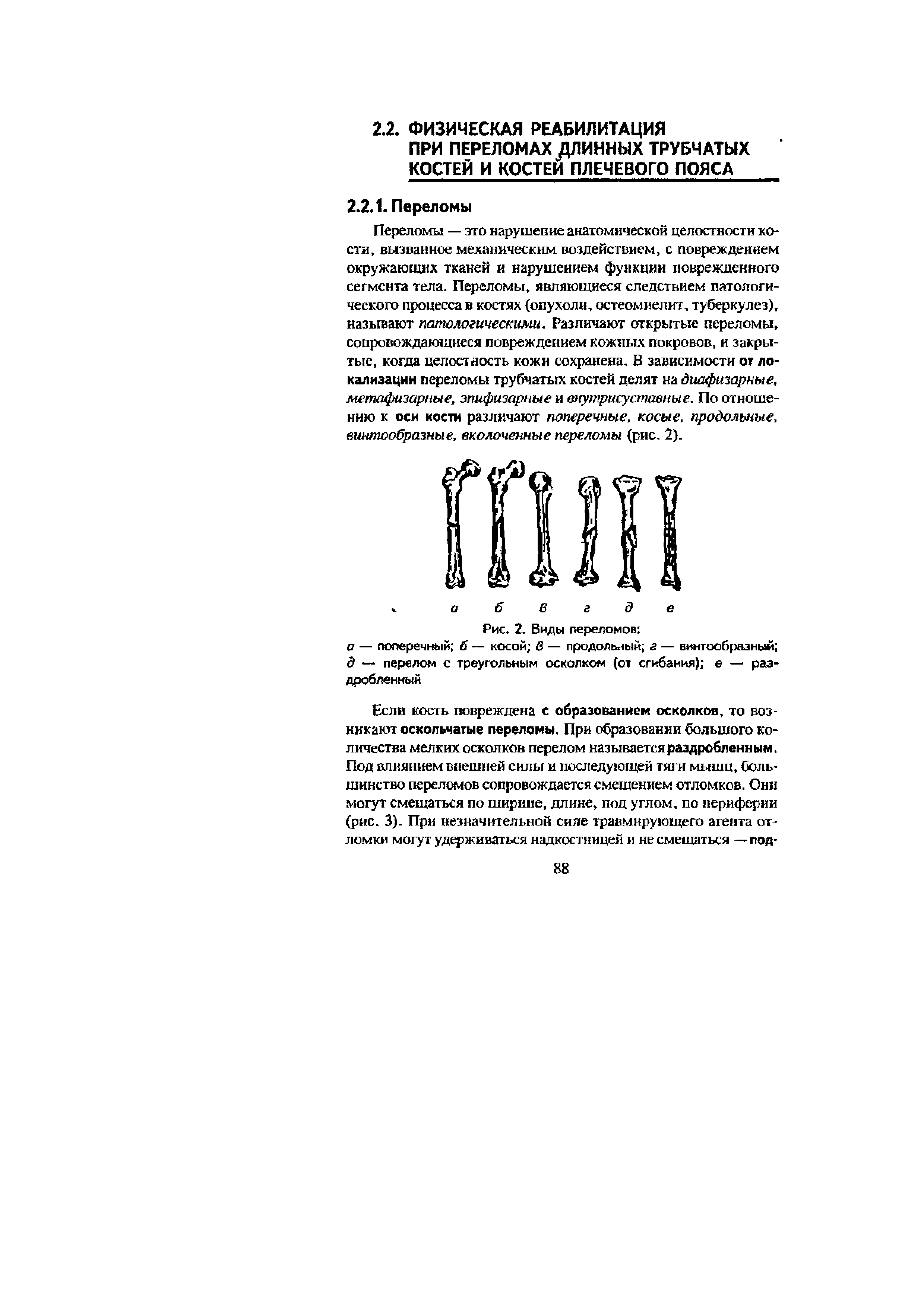Рис. 2. Виды переломов а — поперечный б — косой в — продольный г — винтообразный д — перелом с треугольным осколком (от сгибания) е — раздробленный...