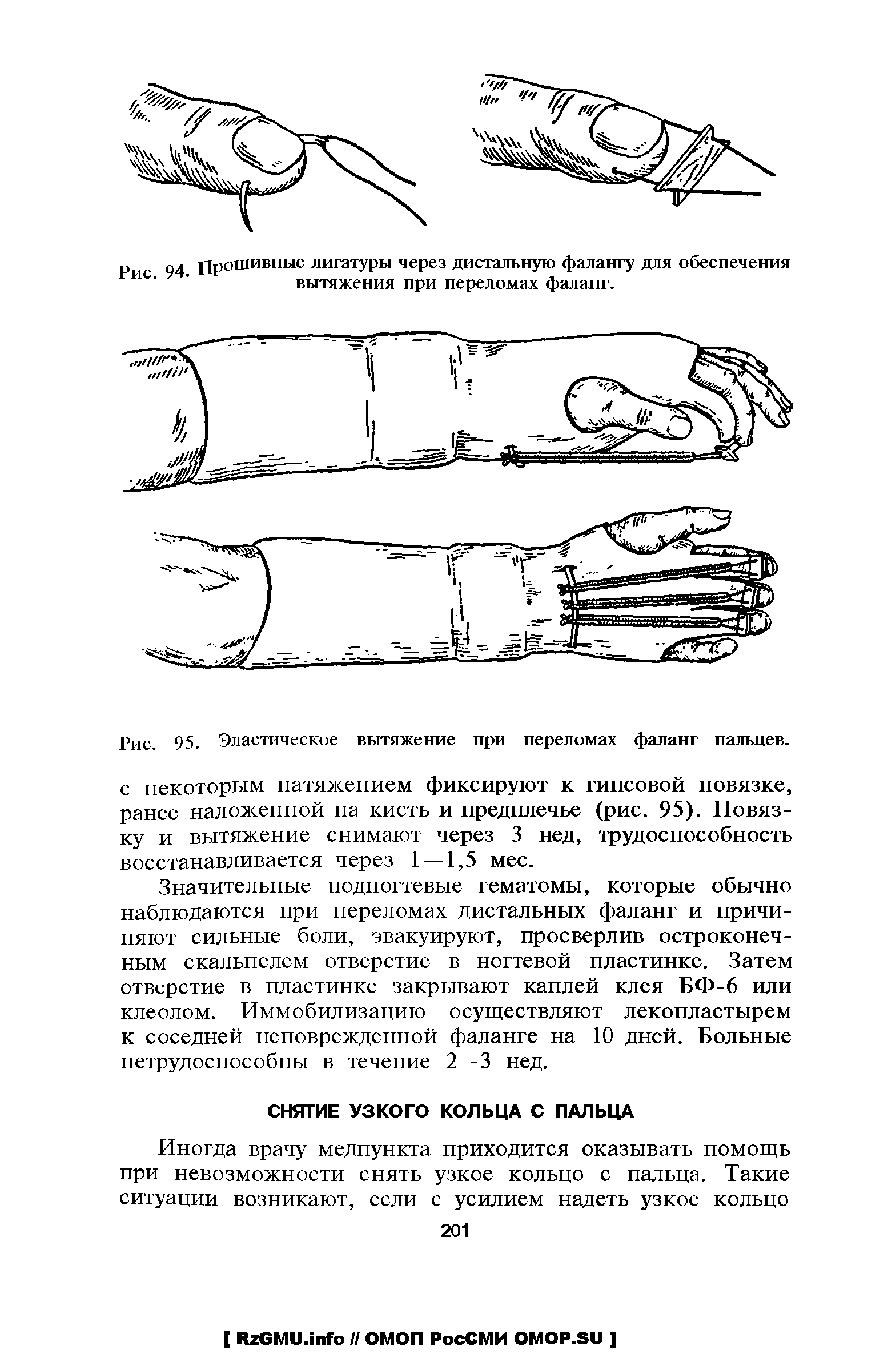 Рис. 95. Эластическое вытяжение при переломах фаланг пальцев, с некоторым натяжением фиксируют к гипсовой повязке, ранее наложенной на кисть и предплечье (рис. 95). Повязку и вытяжение снимают через 3 нед, трудоспособность восстанавливается через 1 — 1,5 мес.