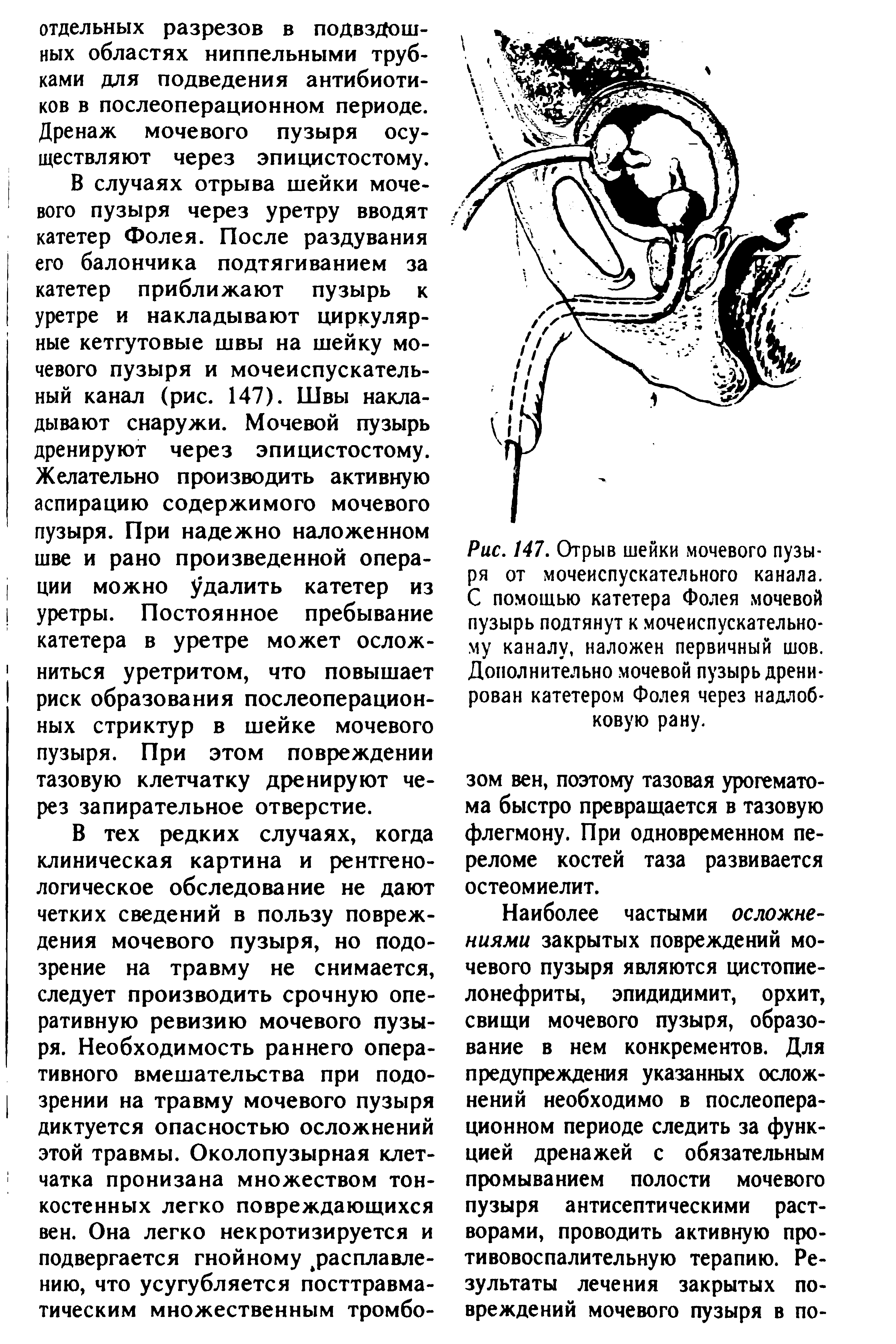 Рис. 147, Отрыв шейки мочевого пузыря от мочеиспускательного канала. С помощью катетера Фолея мочевой пузырь подтянут к мочеиспускательному каналу, наложен первичный шов. Дополнительно мочевой пузырь дренирован катетером Фолея через надлобковую рану.