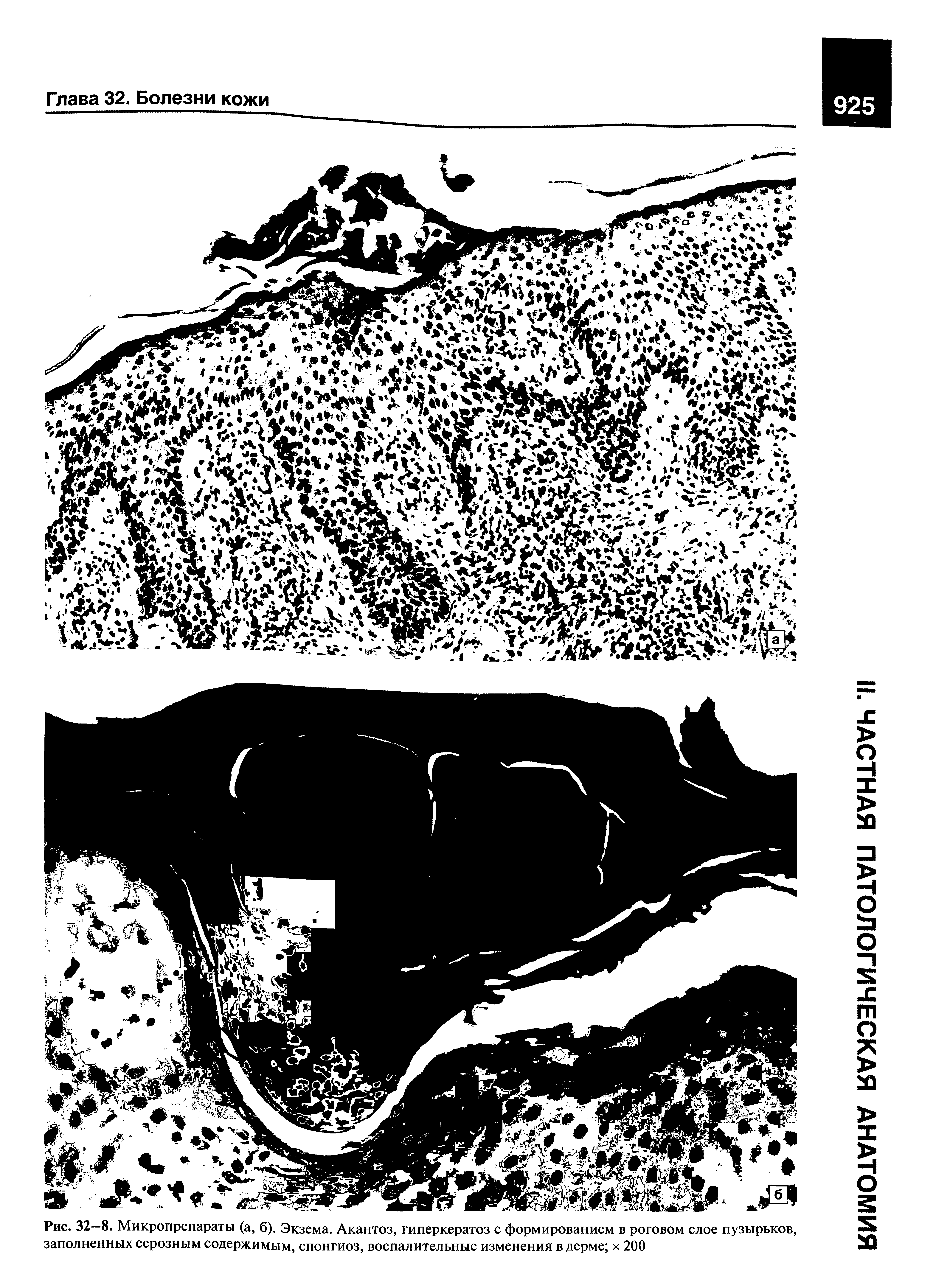 Рис. 32—8. Микропрепараты (а, б). Экзема. Акантоз, гиперкератоз с формированием в роговом слое пузырьков, заполненных серозным содержимым, спонгиоз, воспалительные изменения в дерме х 200...