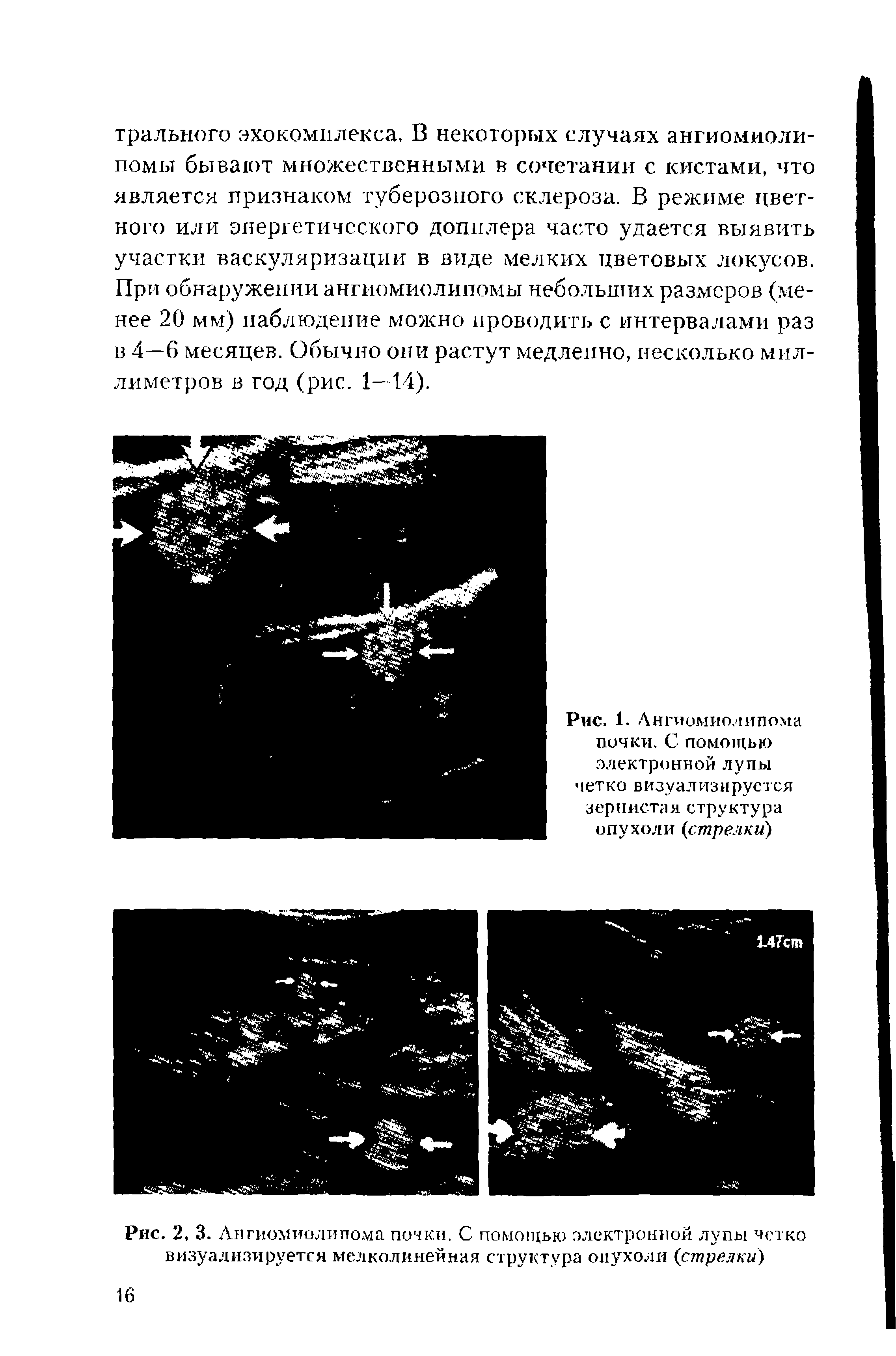 Рис. 1. Ангиомиолипома почки. С помощью. электронной лупы четко визуализируется зернистая структура опухоли стрелки)...