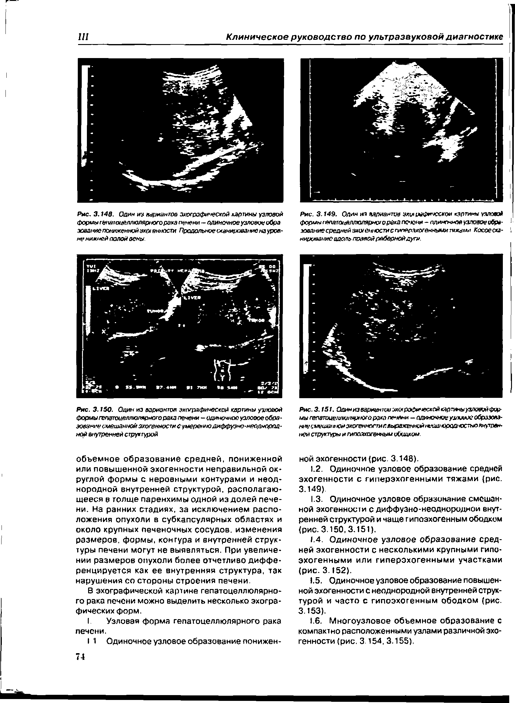 Рис. 3.150. Один из вариантов зхлгрлфимосгой картины узловой формы гепатоцеллюлярного рака печени — одиночное узловое образован смешанной охогенностн с умеренно диффузно-нееднорпд-ной ыутренней структурой...