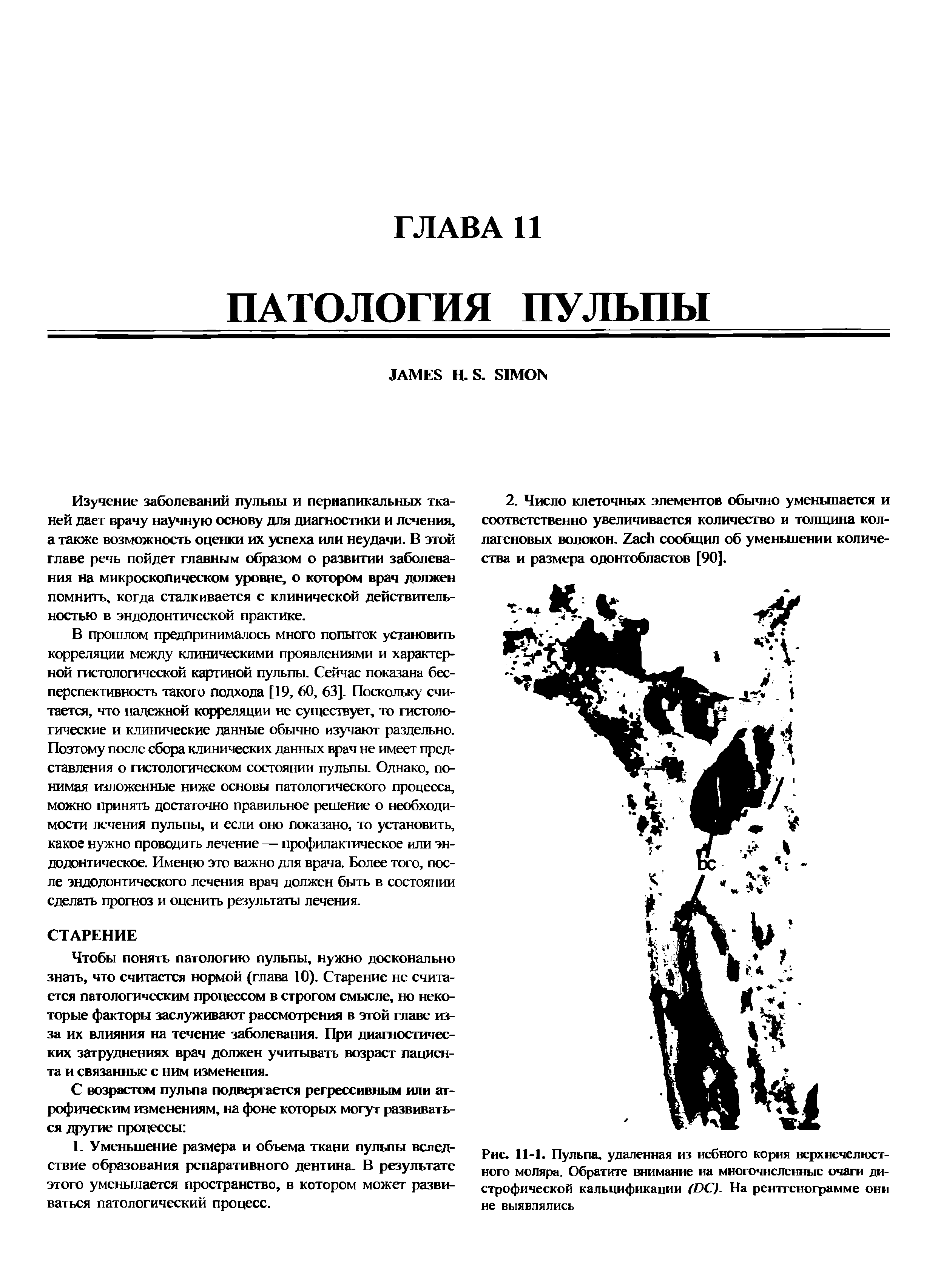 Рис. 11-1. Пульпа, удаленная из небного корня верхнечелюстного моляра. Обратите внимание на многочисленные очаги дистрофической кальцификации (ОС). На рентгенограмме они не выявлялись...