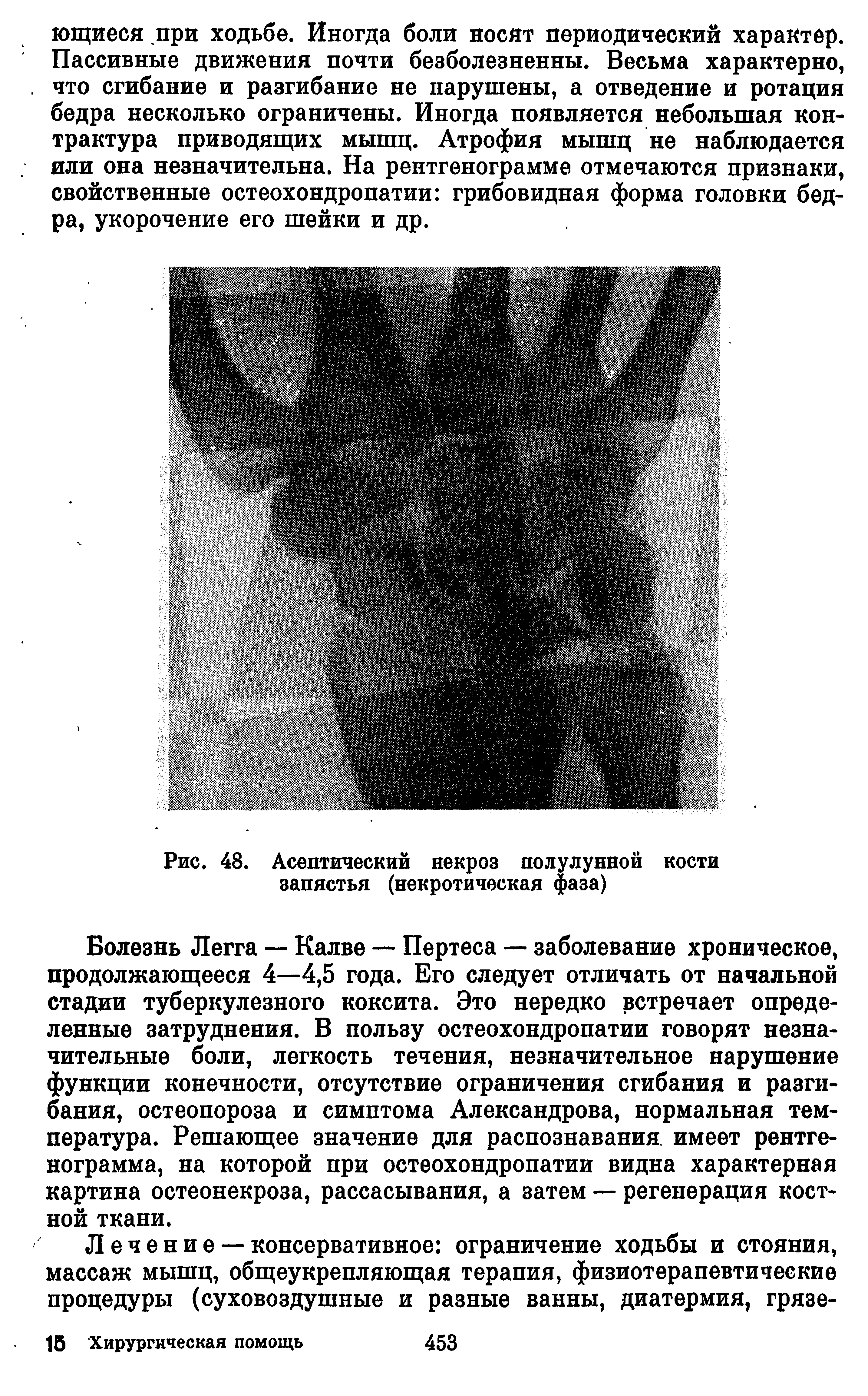 Рис. 48. Асептический некроз полулунной кости запястья (некротическая фаза)...