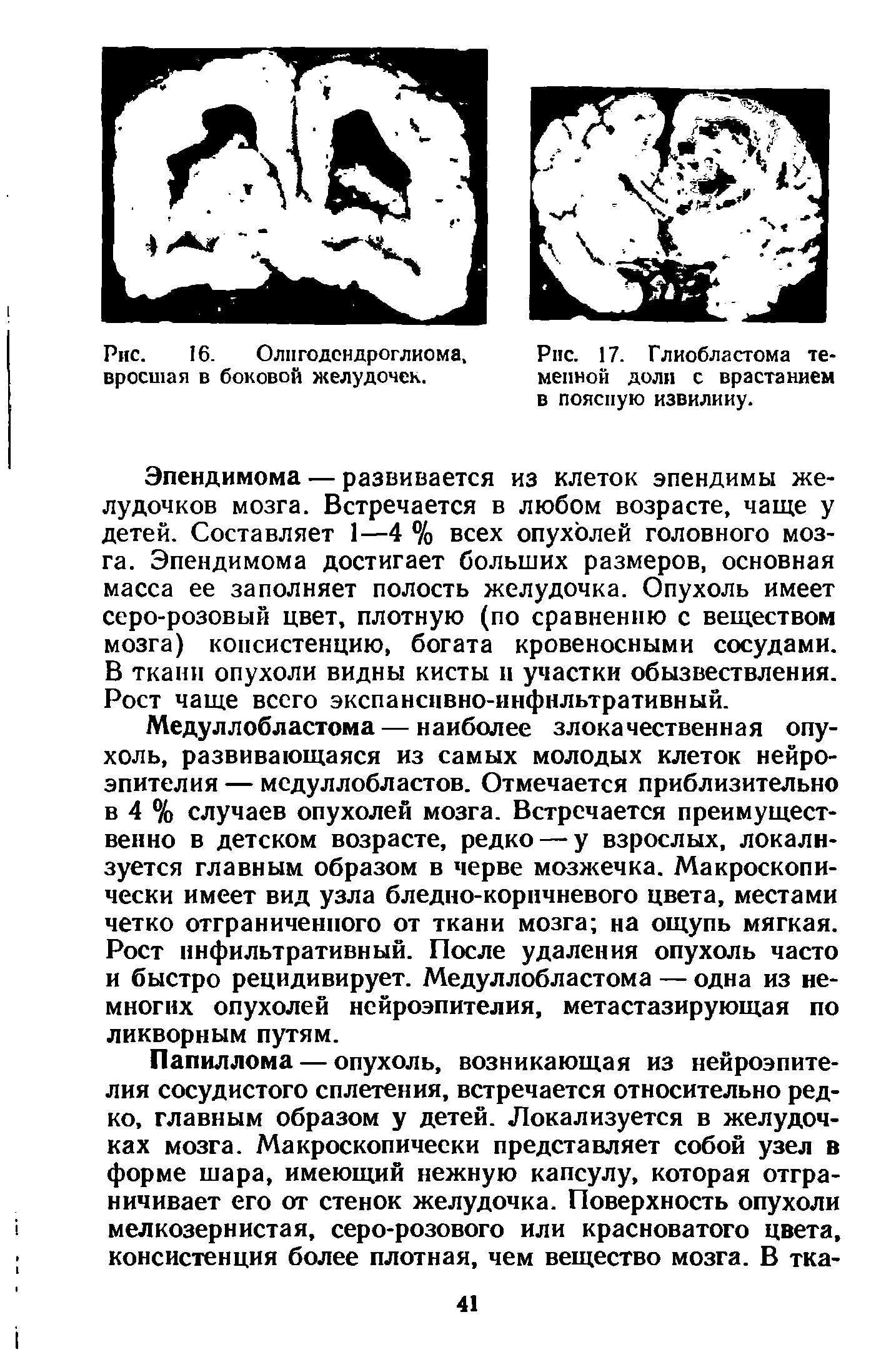 Рис. 17. Глиобластома теменной доли с врастанием в поясную извилииу.