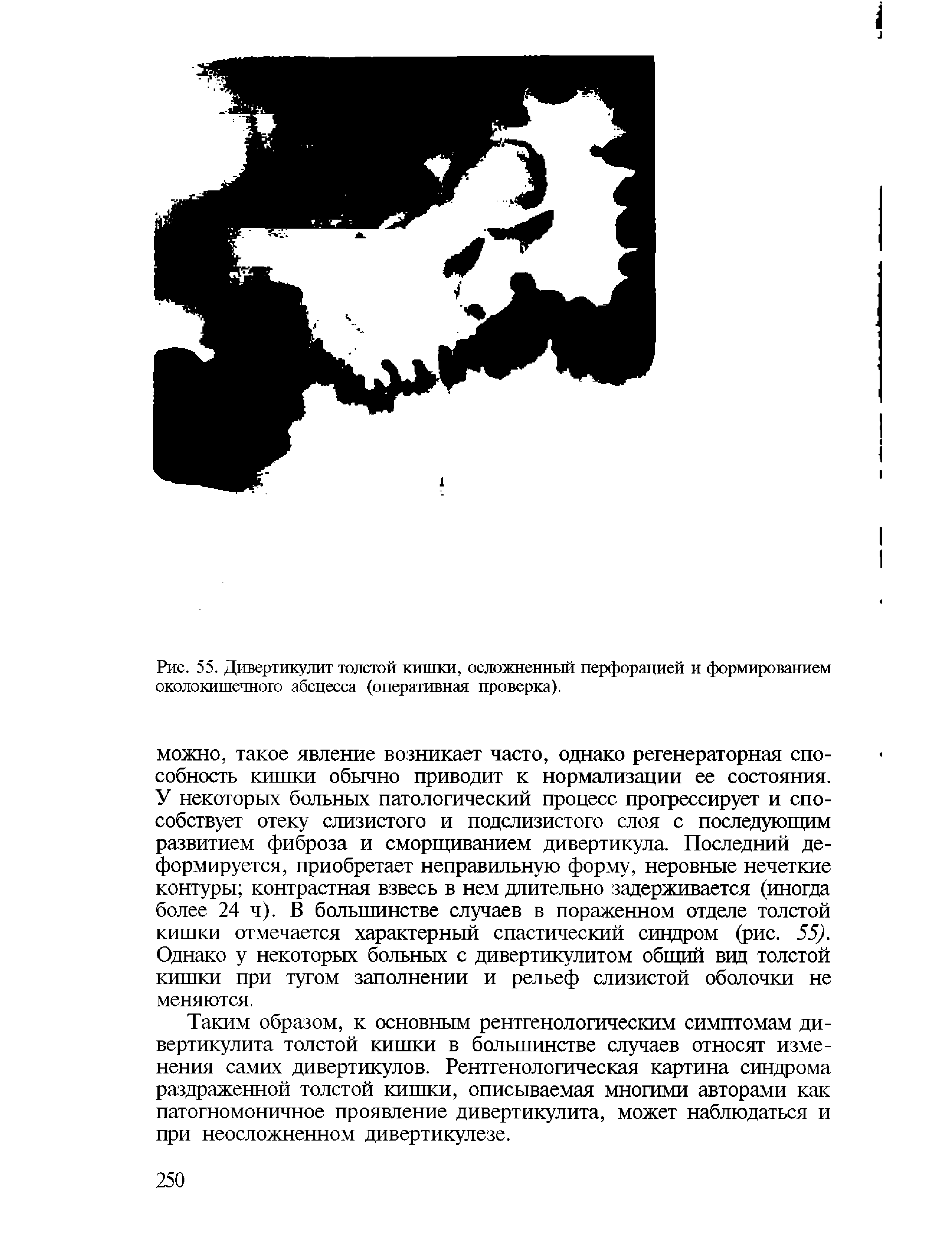 Рис. 55. Дивертикулит толстой кишки, осложненный перфорацией и формированием околокишечного абсцесса (оперативная проверка).