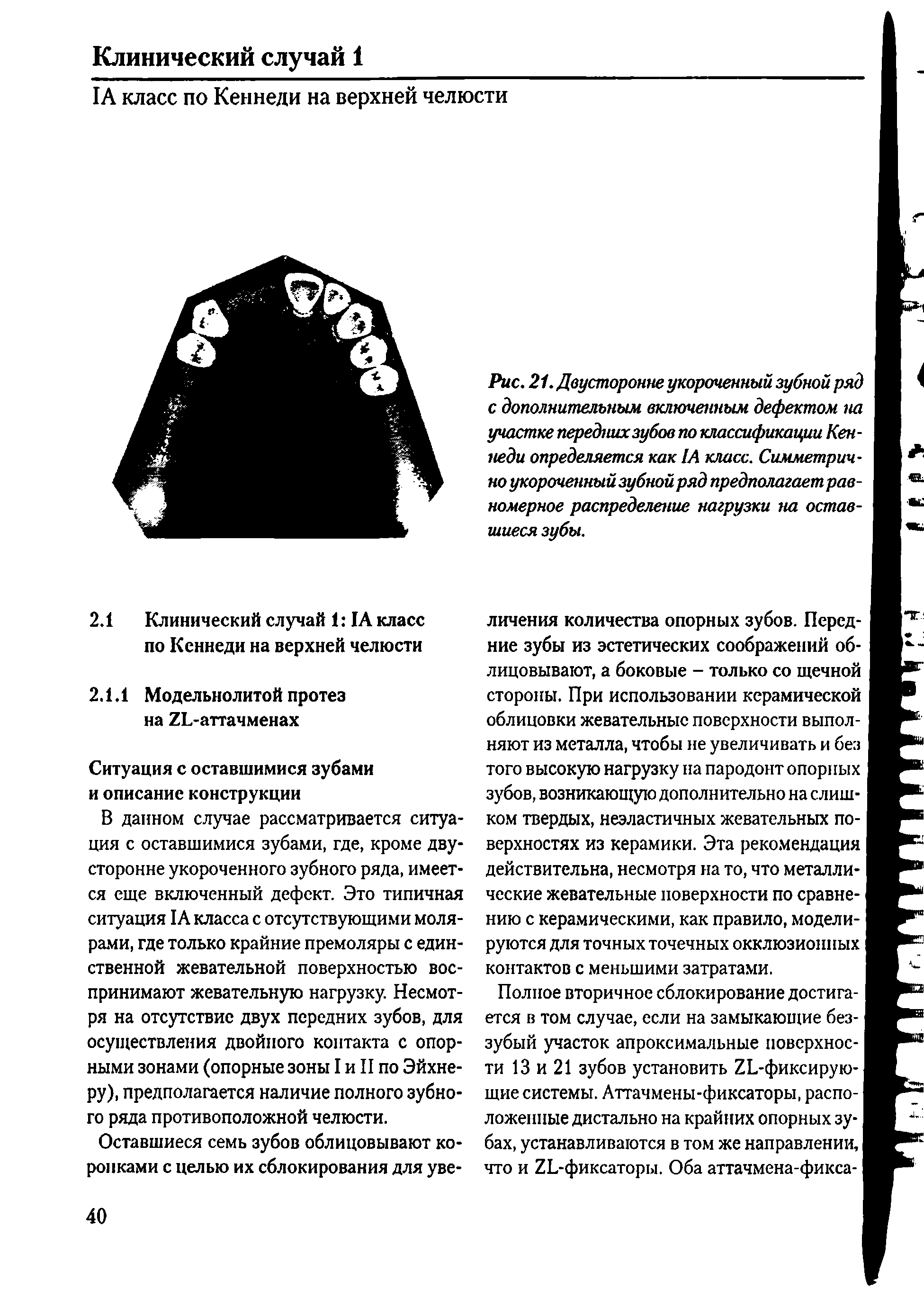 Рис. 21. Двусторонне укороченный зубной ряд с дополнительным включенным дефектом на участке передних зубов по классификации Кеннеди определяется как 1А класс. Симметрично укороченный зубной ряд предполагаетрав-номерное распределение нагрузки на оставшиеся зубы.