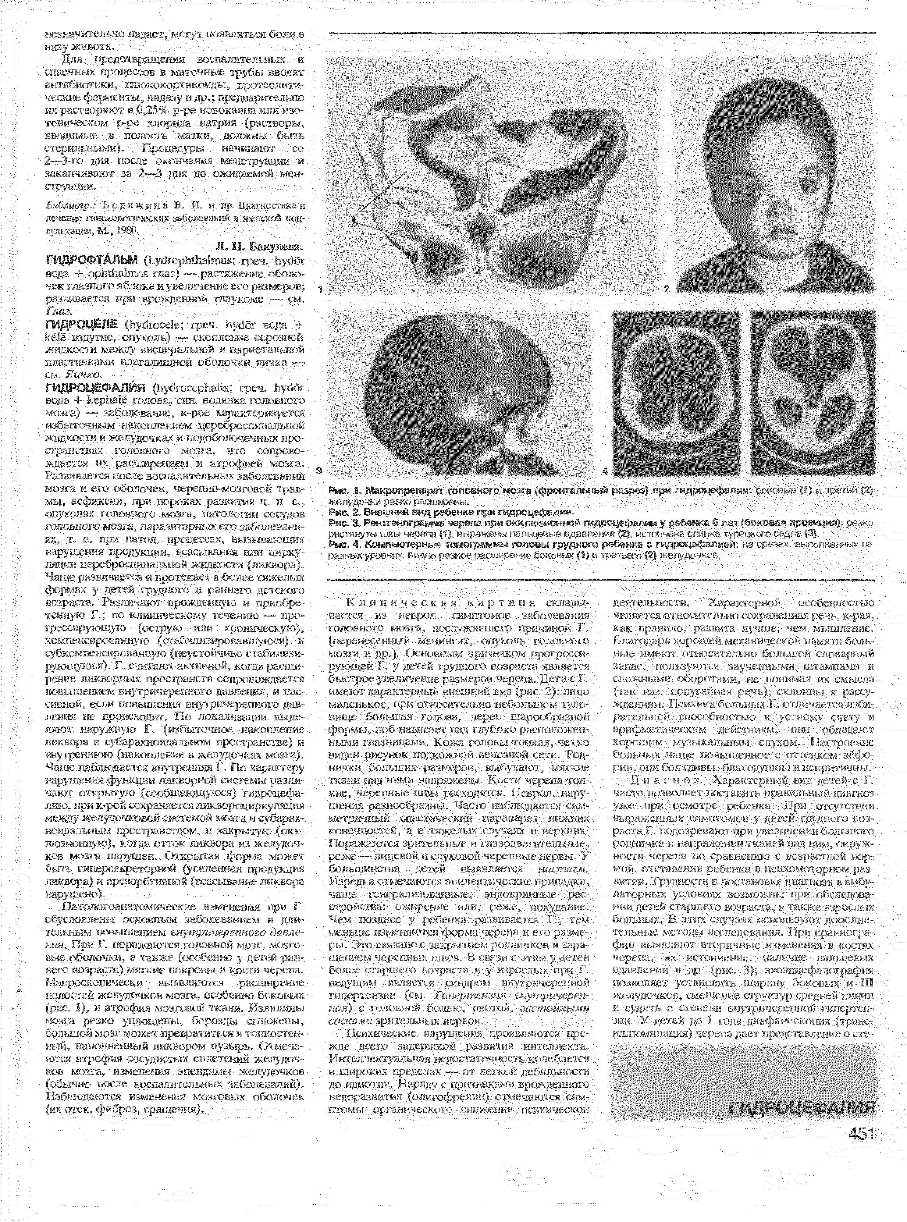 Рис. 4. Компьютерные томограммы головы грудного ребенка с гидроцефалией на срезах, выполненных на разных уровнях, видно резкое расширение боковых (1) и треть...