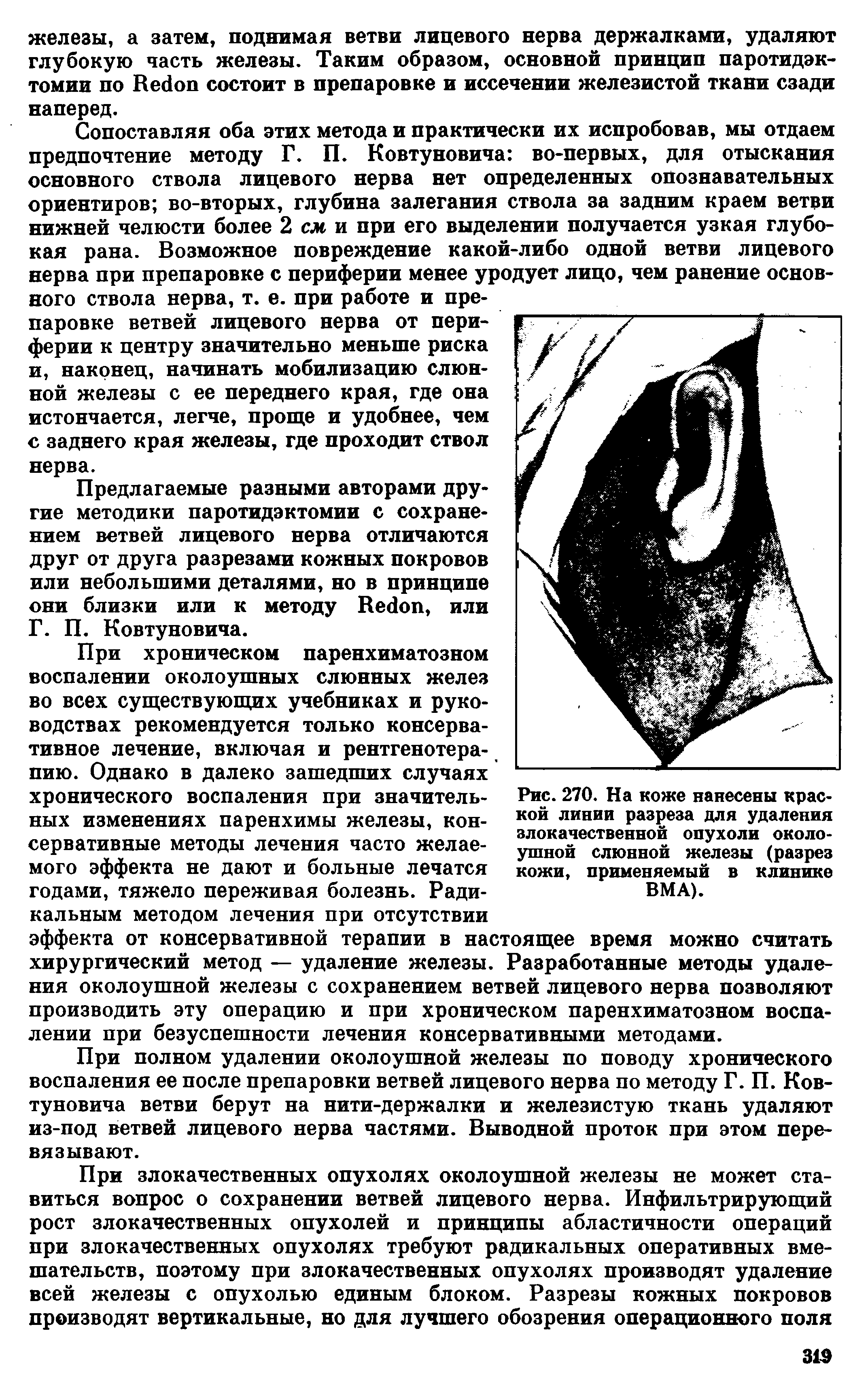 Рис. 270. На коже нанесены краской линии разреза для удаления злокачественной опухоли околоушной слюнной железы (разрез кожи, применяемый в клинике ВМА).