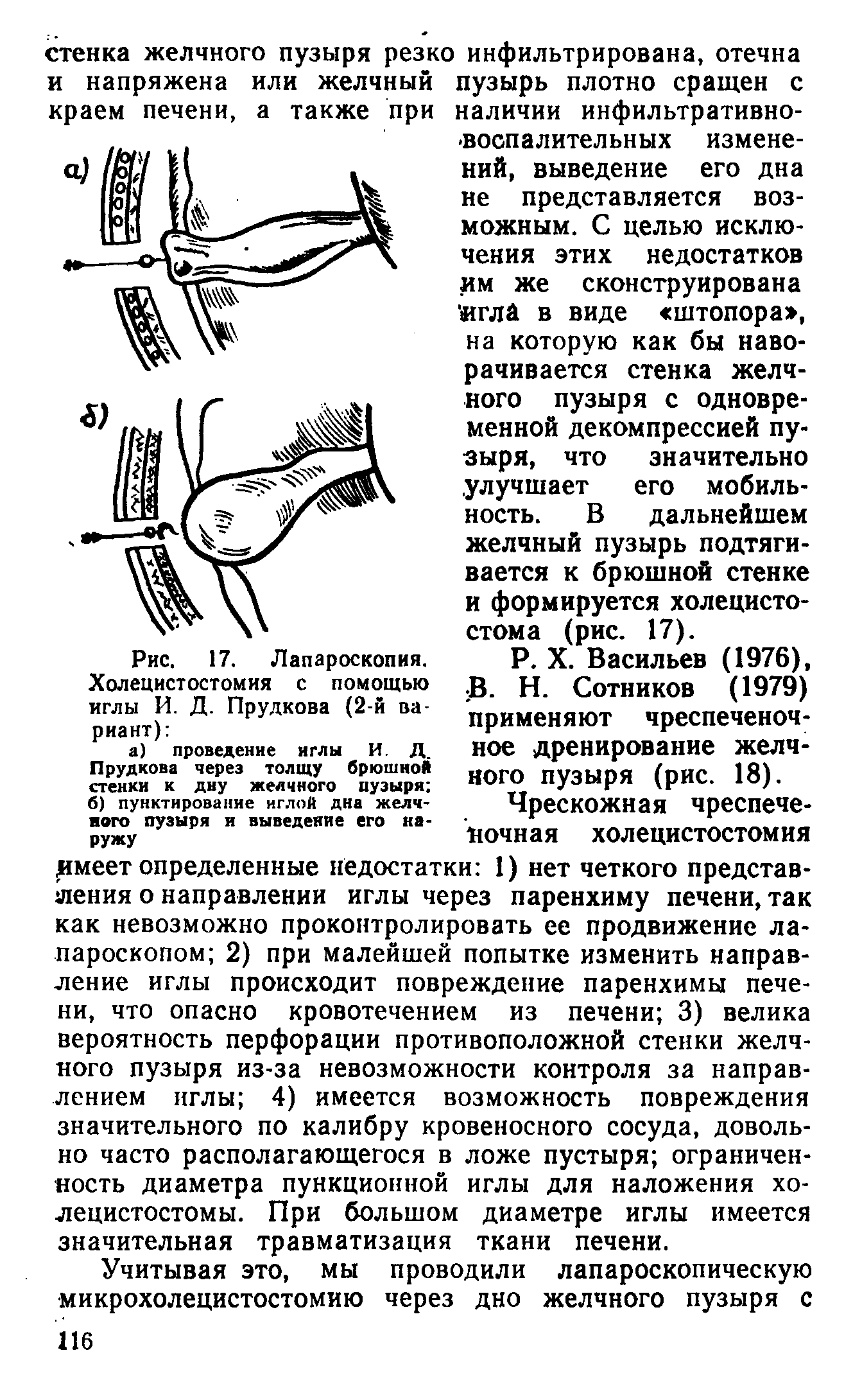 Рис. 17. Лапароскопия. Холецистостомия с помощью иглы И. Д. Прудкова (2-й вариант) ...