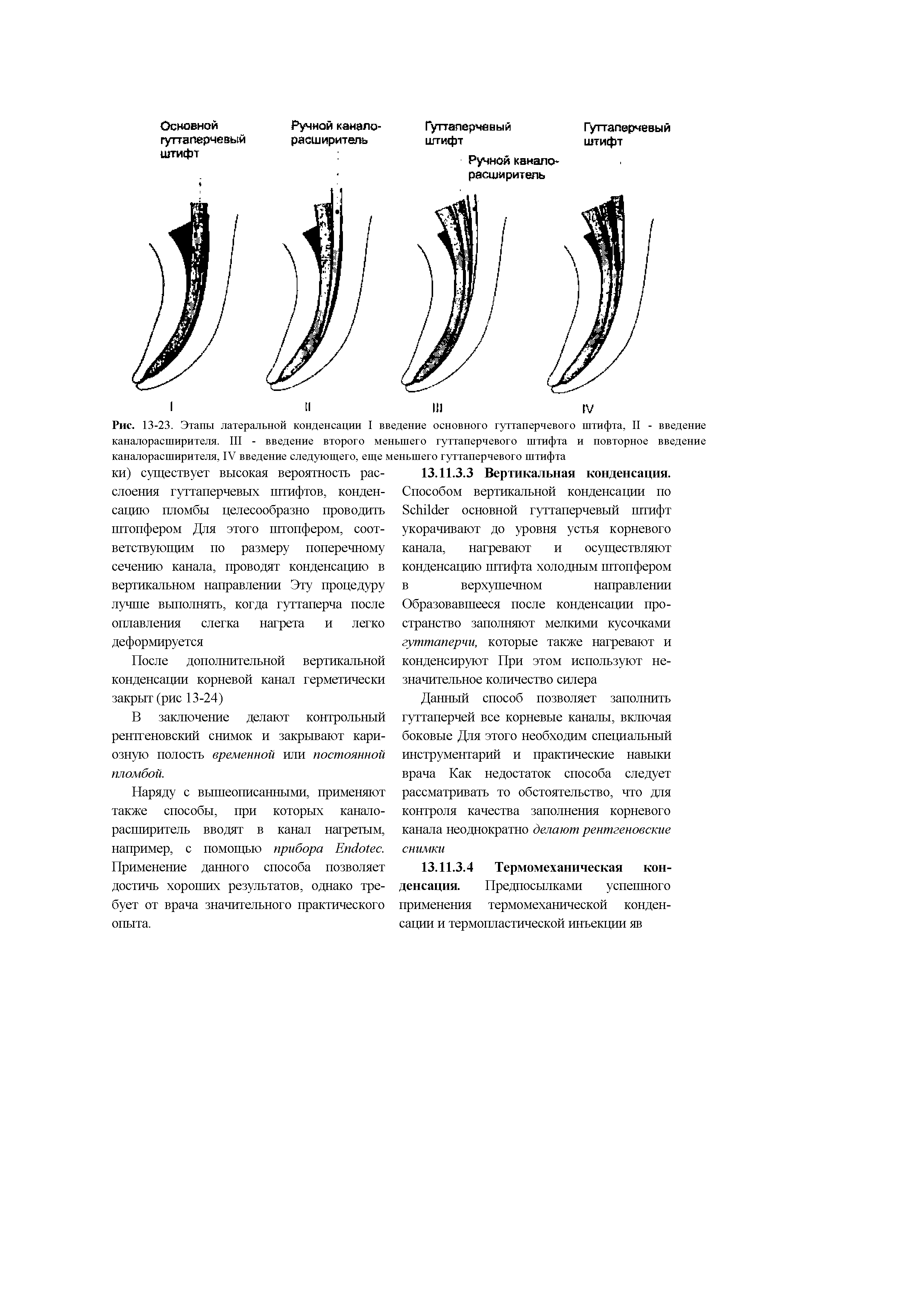 Рис. 13-23. Этапы латеральной конденсации I введение основного гуттаперчевого штифта, II - введение каналорасширителя. III - введение второго меньшего гуттаперчевого штифта и повторное введение каналорасширителя, IV введение следующего, еще меньшего гуттаперчевого штифта...