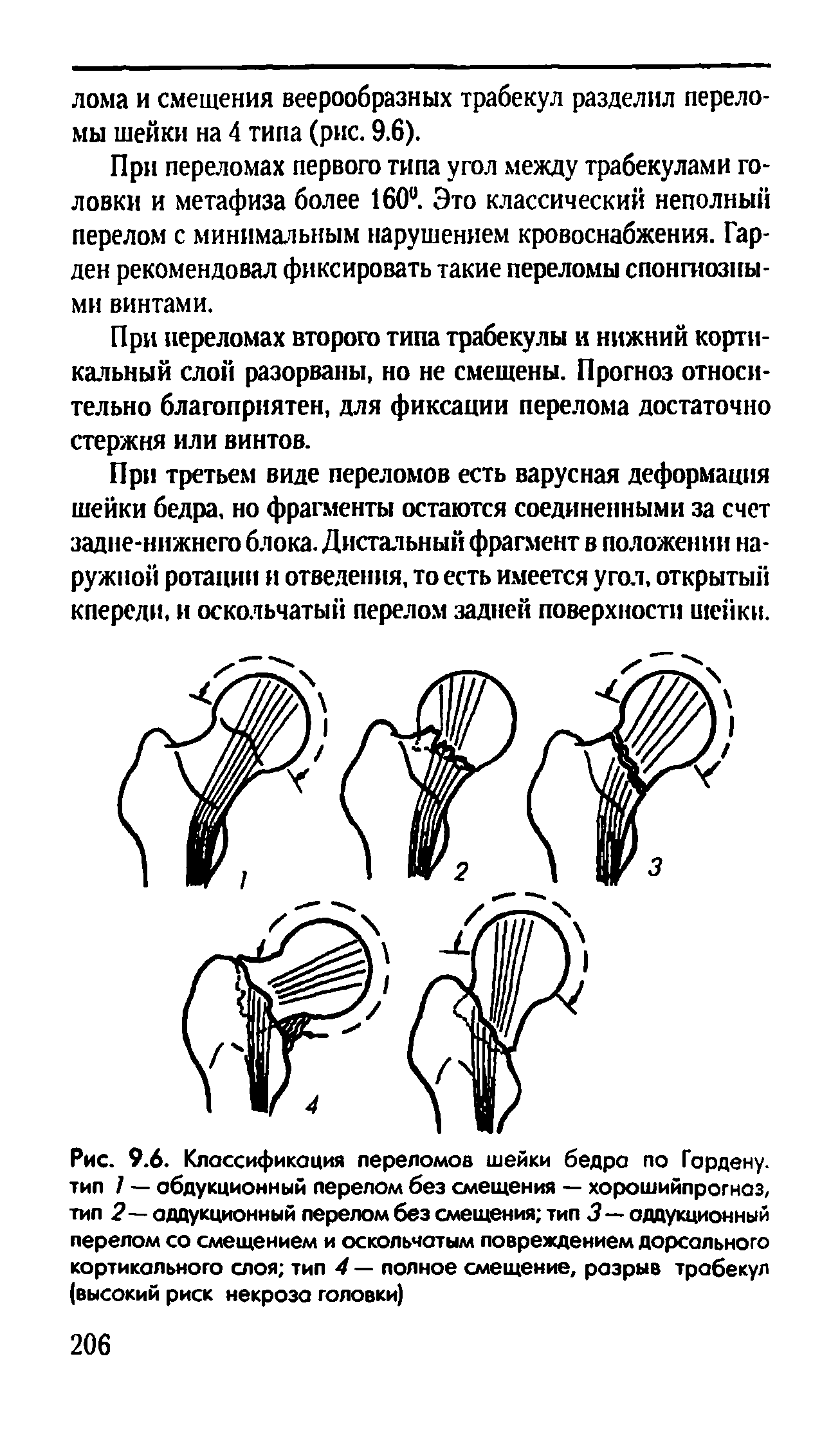 Рис. 9.6. Классификация переломов шейки бедра по Гордену, тип 7 — аддукционный перелом без смещения — хорошийпрогназ, тип 2 аддукционный перелом без смещения тип 3 — аддукционный перелом со смещением и оскольчатым повреждением дорсального кортикального слоя тип 4 — полное смещение, разрыв трабекул (высокий риск некроза головки)...