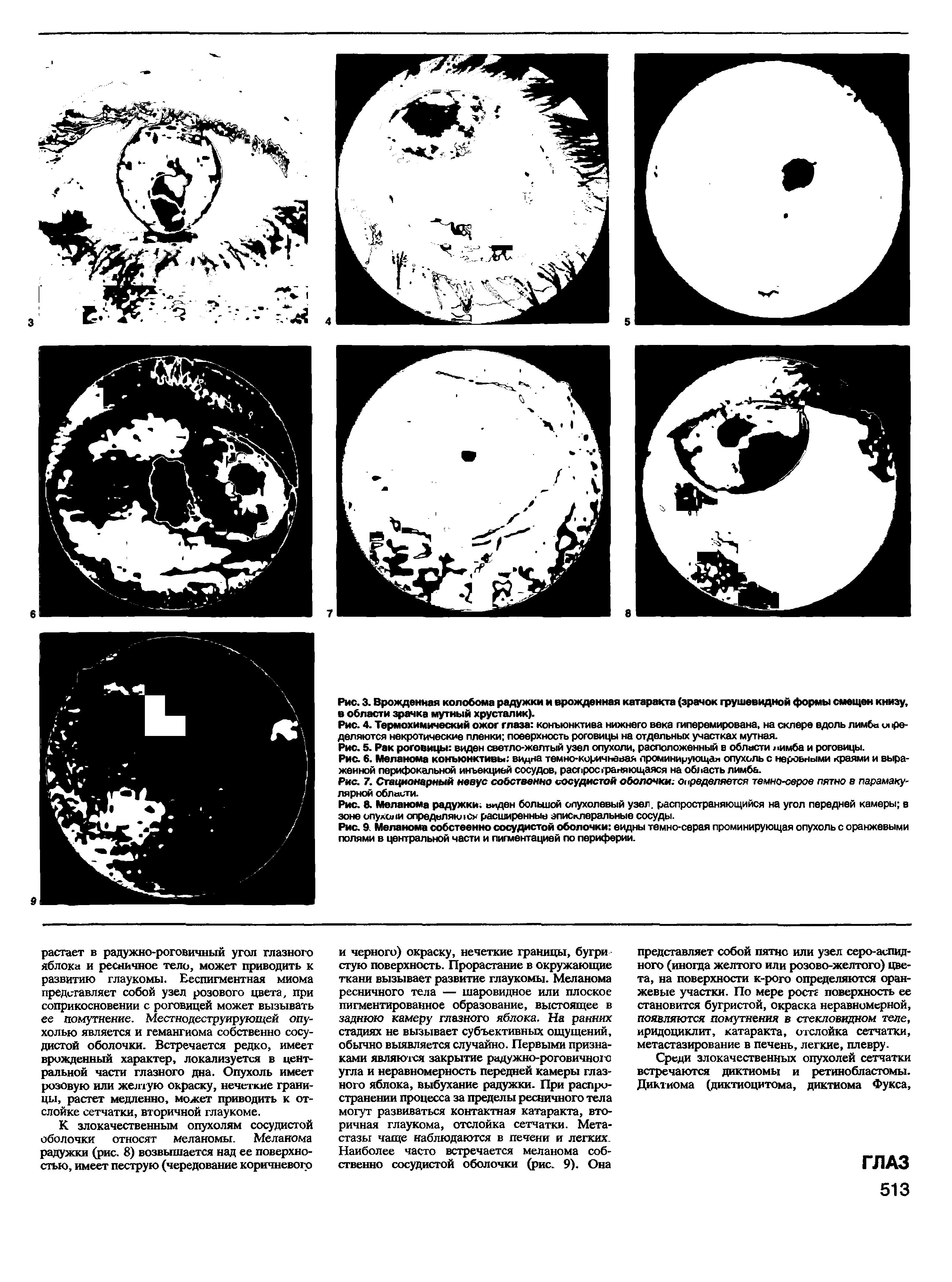 Рис. 7. Стационарный невус собственно сосудистой оболочки.- определяется темно-серое пятно в парамаку-лярной области.