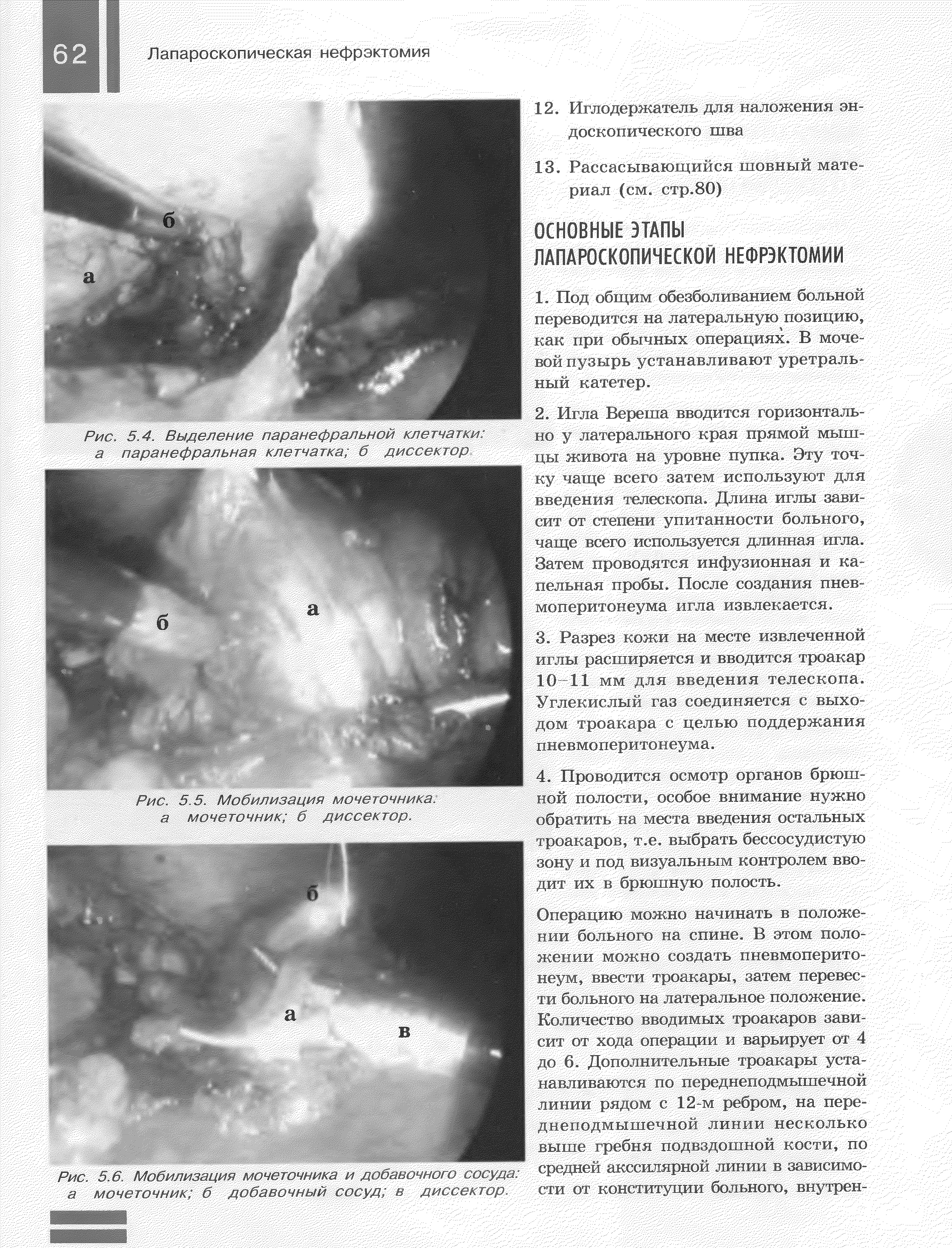 Рис. 5.6. Мобилизация мочеточника и добавочном вое да. а мочеточник б добавочный сосуд в диссектор.