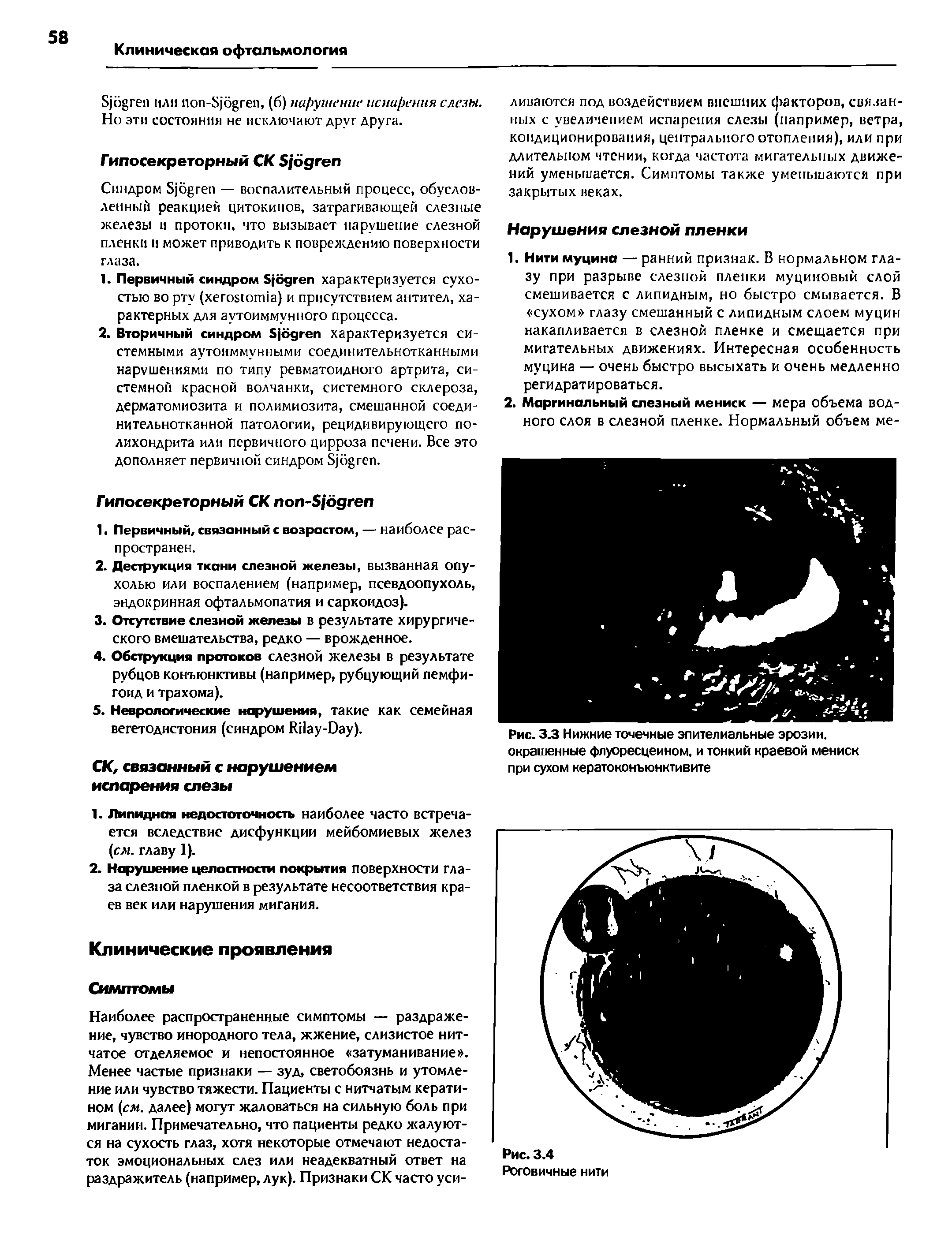 Рис. 3.3 Нижние точечные эпителиальные эрозии, окрашенные флуоресцеином, и тонкий краевой мениск при сухом кератоконъюнктивите...