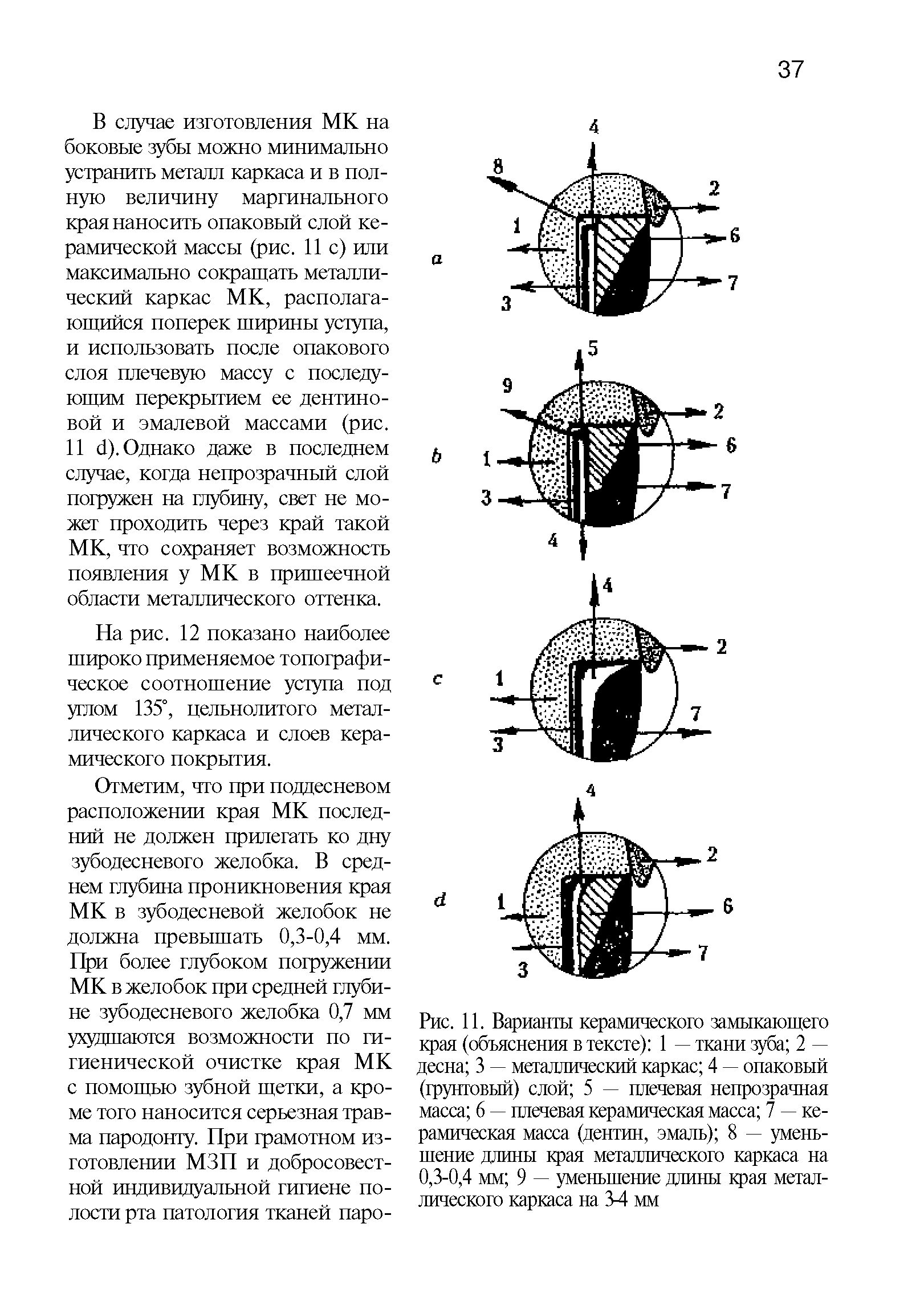 Рис. 11. Варианты керамического замыкающего края (объяснения в тексте) 1 — ткани зуба 2 — десна 3 — металлический каркас 4 — опаковый (грунтовый) слой 5 — плечевая непрозрачная масса 6 — плечевая керамическая масса 7 — керамическая масса (дентин, эмаль) 8 — уменьшение длины края металлического каркаса на 0,3-0,4 мм 9 — уменьшение длины края металлического каркаса на 3-4 мм...