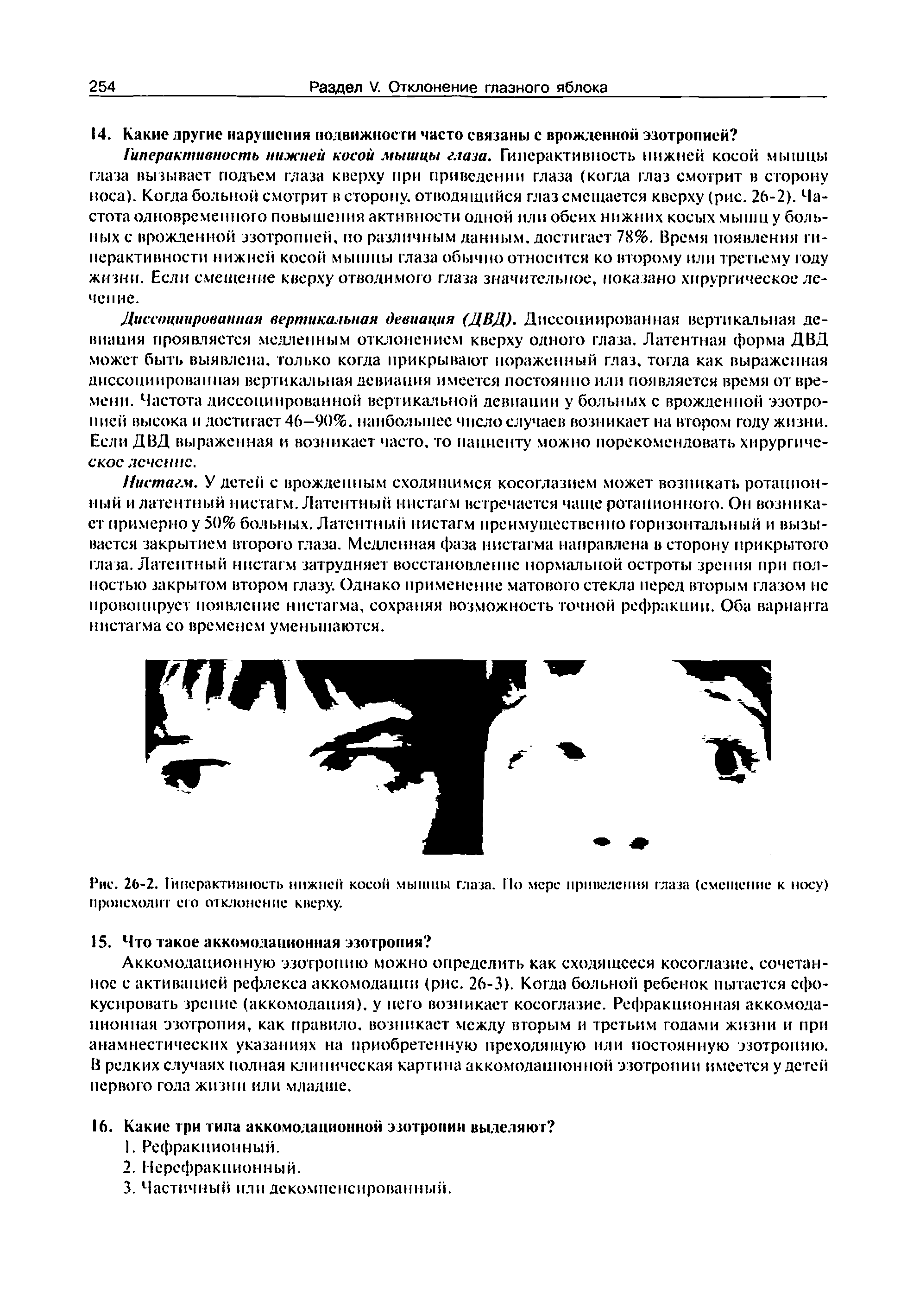 Рис. 26-2. Гиперактивность нижней косой мышцы глаза. По мере приведения глаза (смешение к носу) происходит его отклонение кверху.