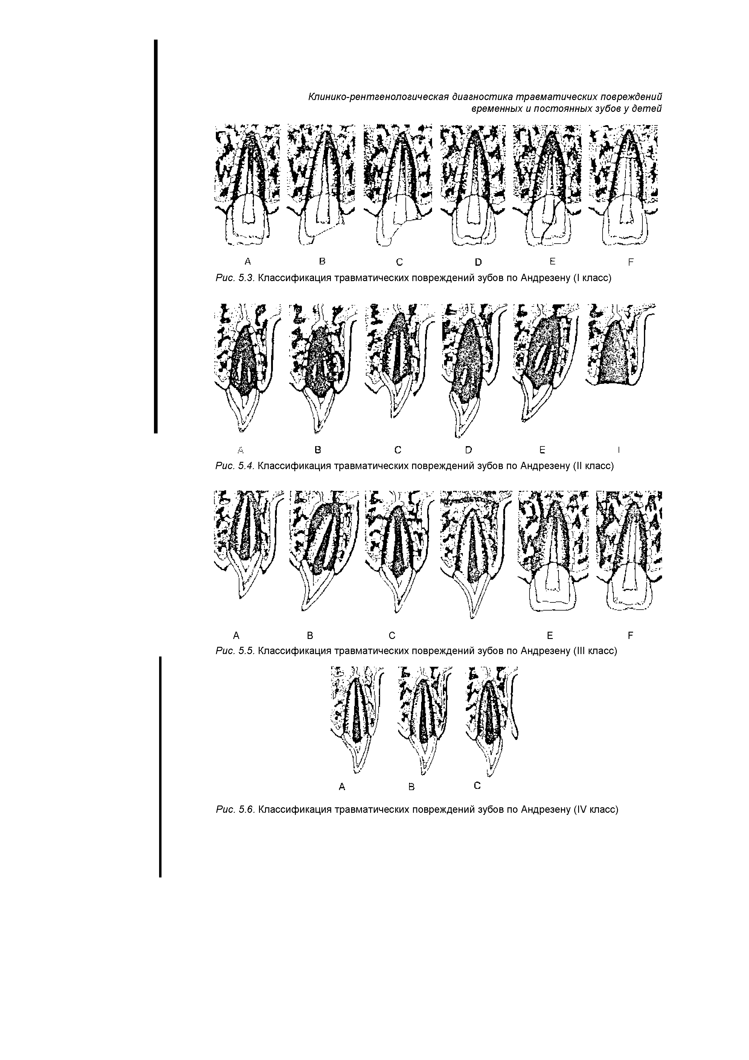Рис. 5.3. Классификация травматических повреждений зубов по Андрезену (I класс)...