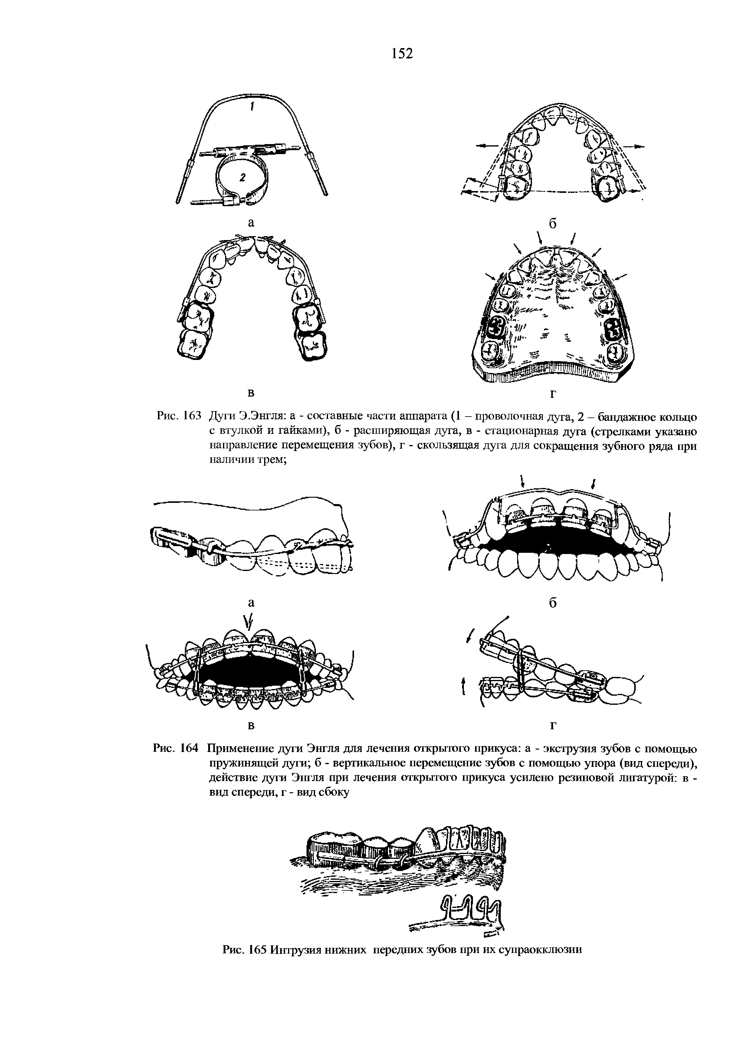 Рис. 163 Дуги Э.Энгля а - составные части аппарата (1 - проволочная дуга, 2 - бандажное кольцо с втулкой и гайками), б - расширяющая дуга, в - стационарная дуга (стрелками указано направление перемещения зубов), г - скользящая дуга для сокращения зубного ряда при наличии трем ...