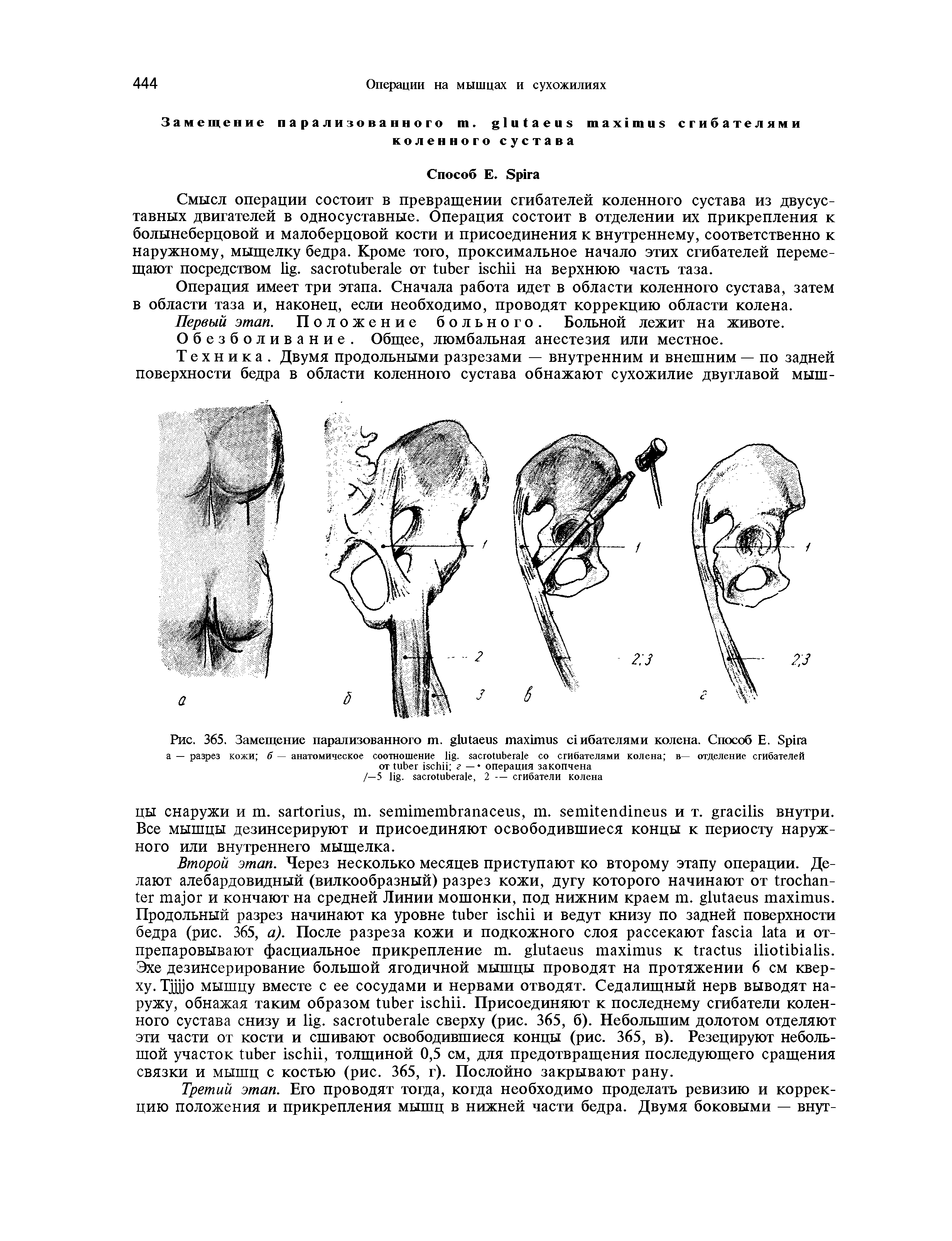 Рис. 365. Замещение парализованного . сгибателями колена. Способ Е. S а — разрез кожи б — анатомическое соотношение . со сгибателями колена в— отделение сгибателей от г — операция закопчена...