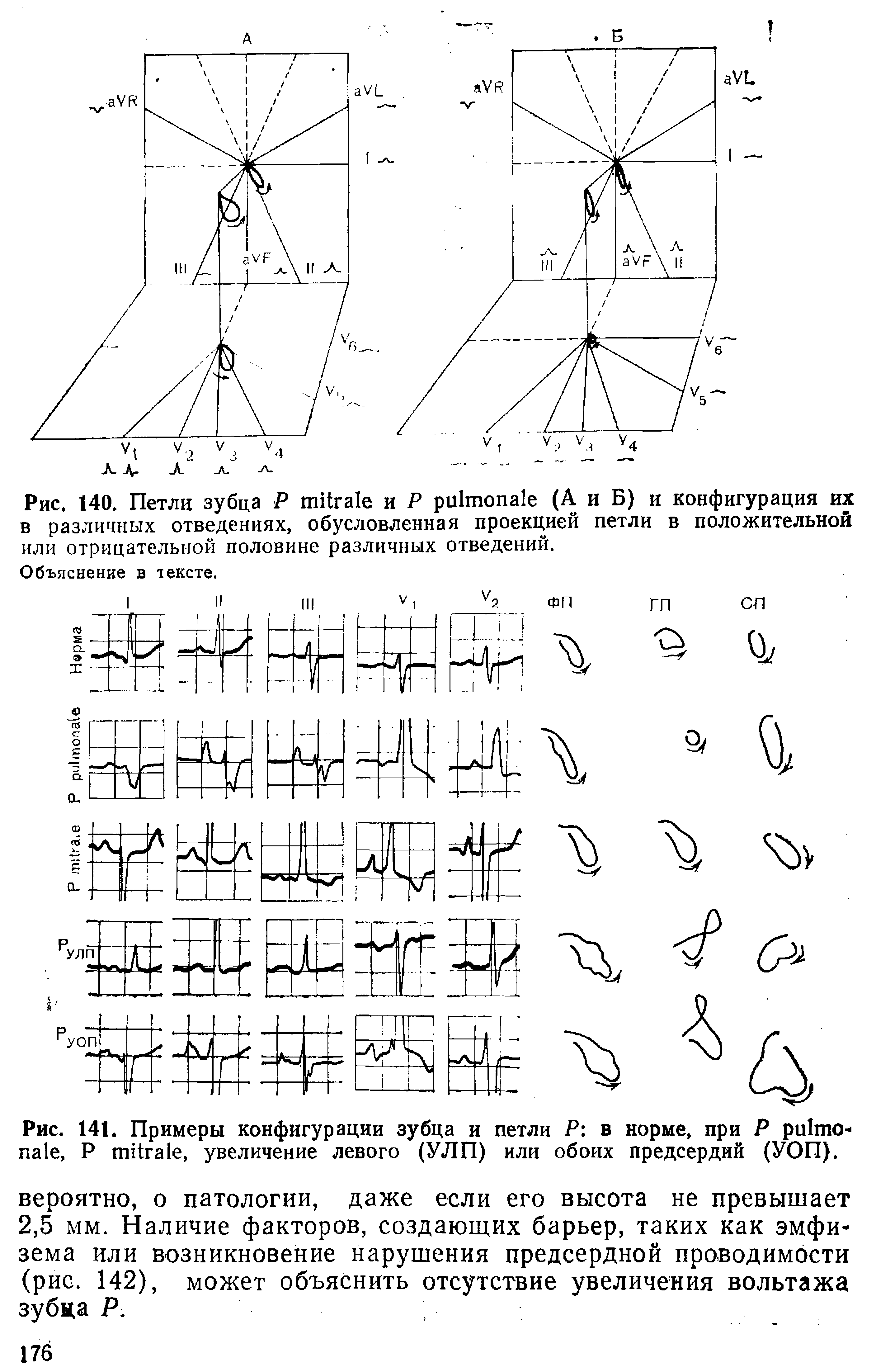 Рис. 140. Петли зубца Р и Р (А и Б) и конфигурация их в различных отведениях, обусловленная проекцией петли в положительной или отрицательной половине различных отведений.